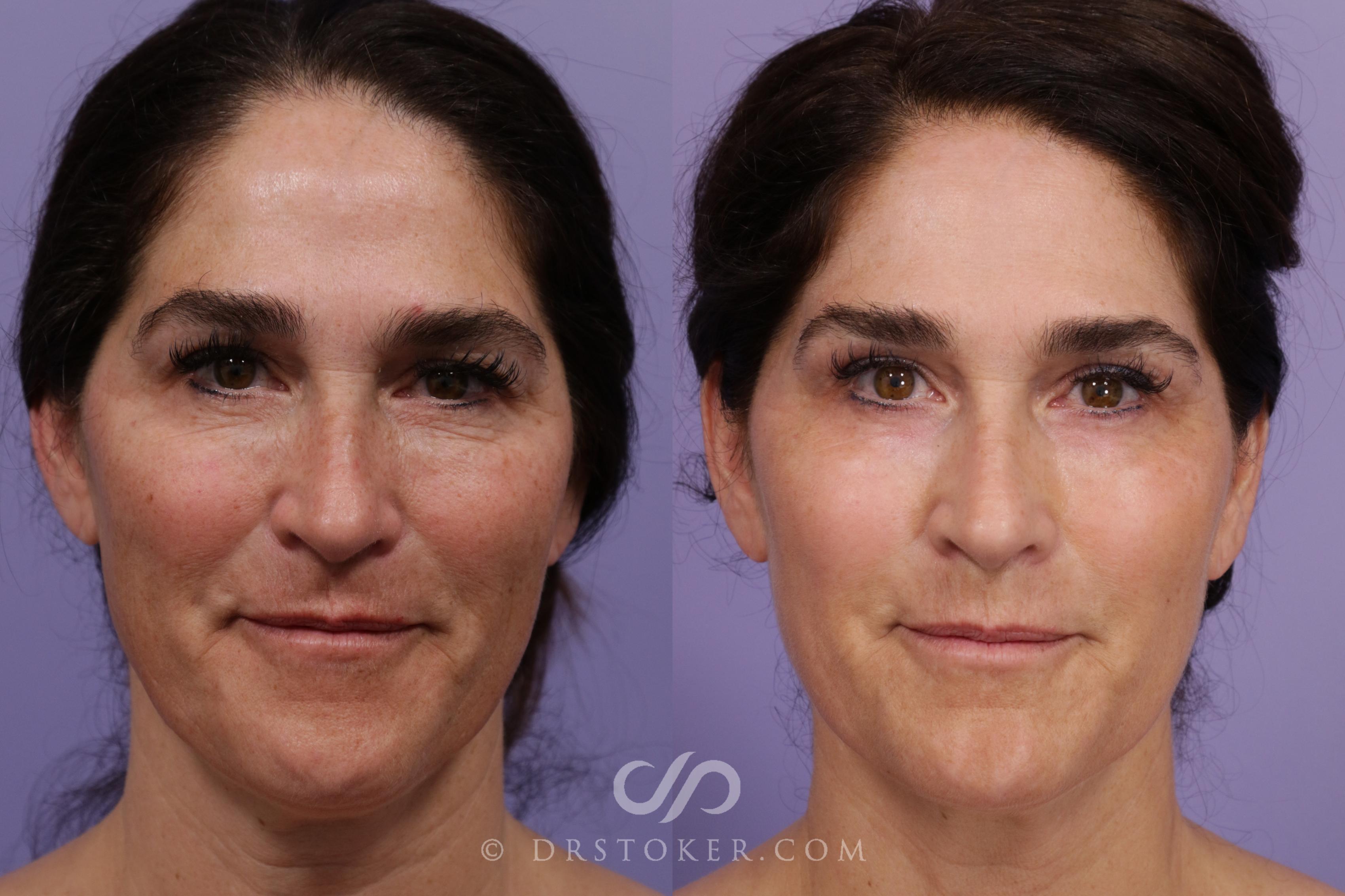 Before & After Laser Skin Resurfacing  Case 1908 Front View in Los Angeles, CA
