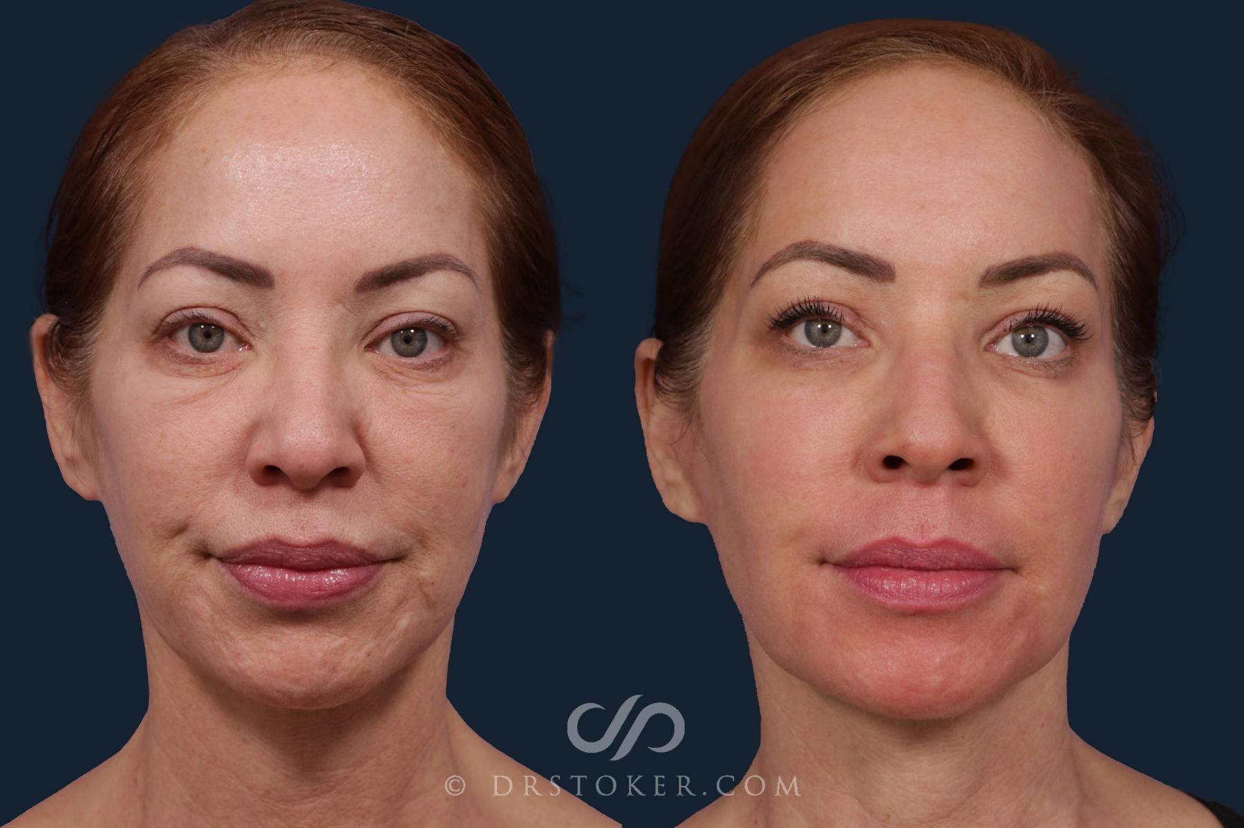 Before & After Laser Skin Resurfacing  Case 2035 Front View in Los Angeles, CA