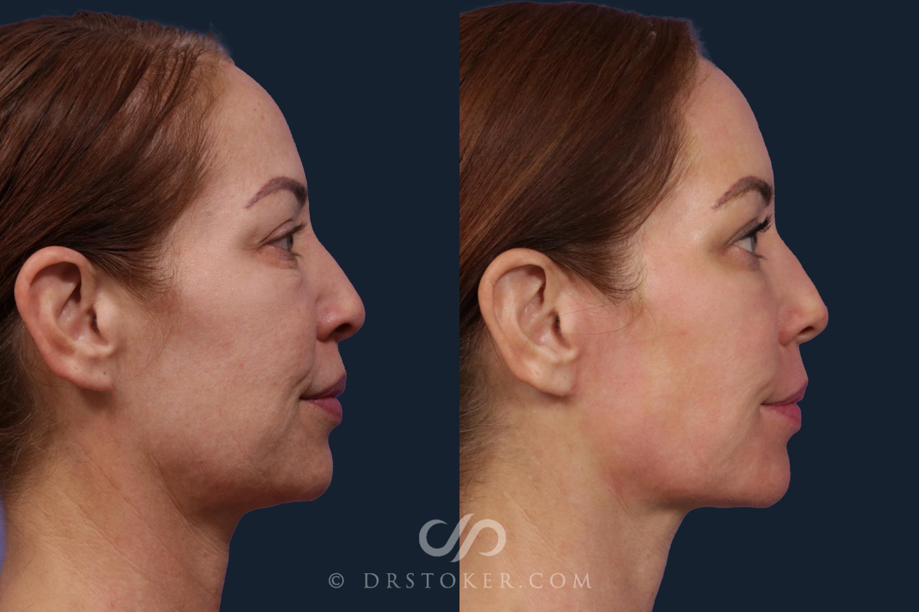 Before & After Laser Skin Resurfacing  Case 2035 Right Side View in Los Angeles, CA