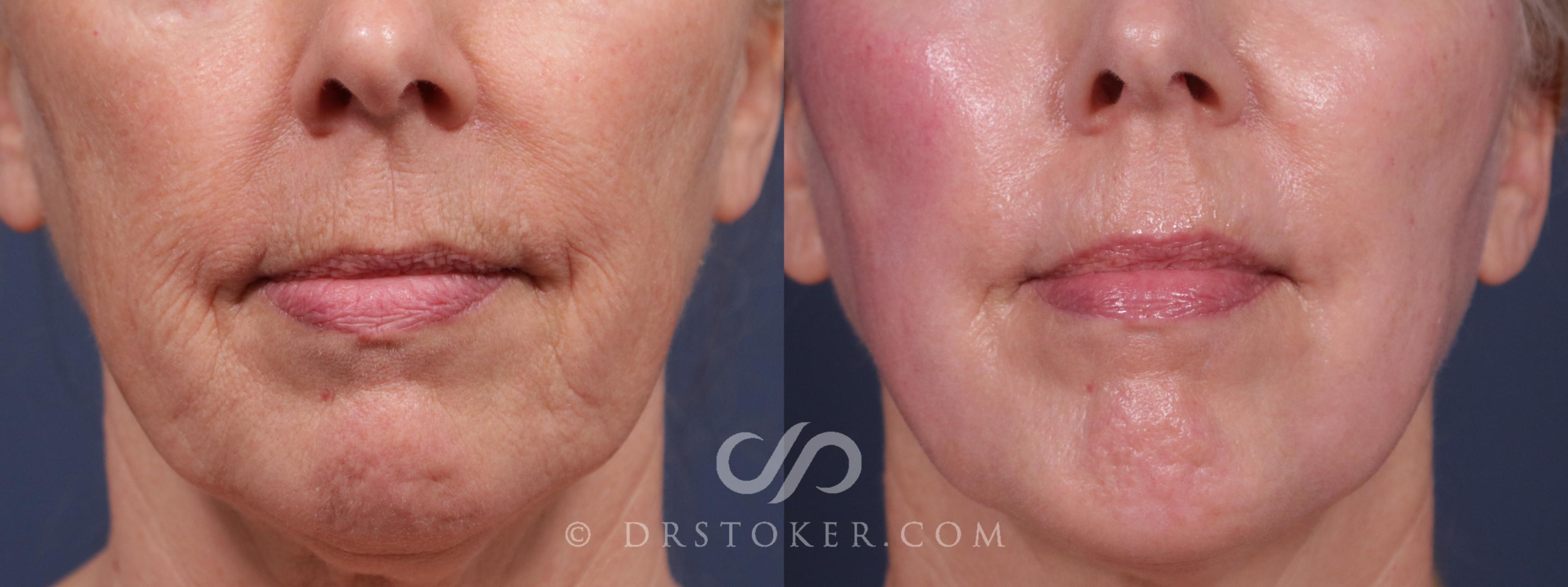 Before & After Laser Skin Resurfacing (Mouth) Case 2189 Front View in Los Angeles, CA