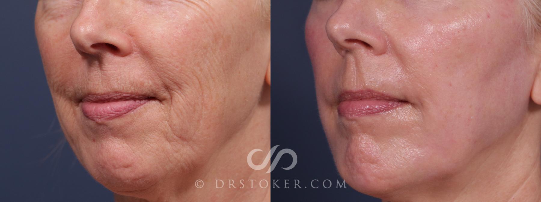 Before & After Laser Skin Resurfacing (Mouth) Case 2189 Left Oblique View in Los Angeles, CA