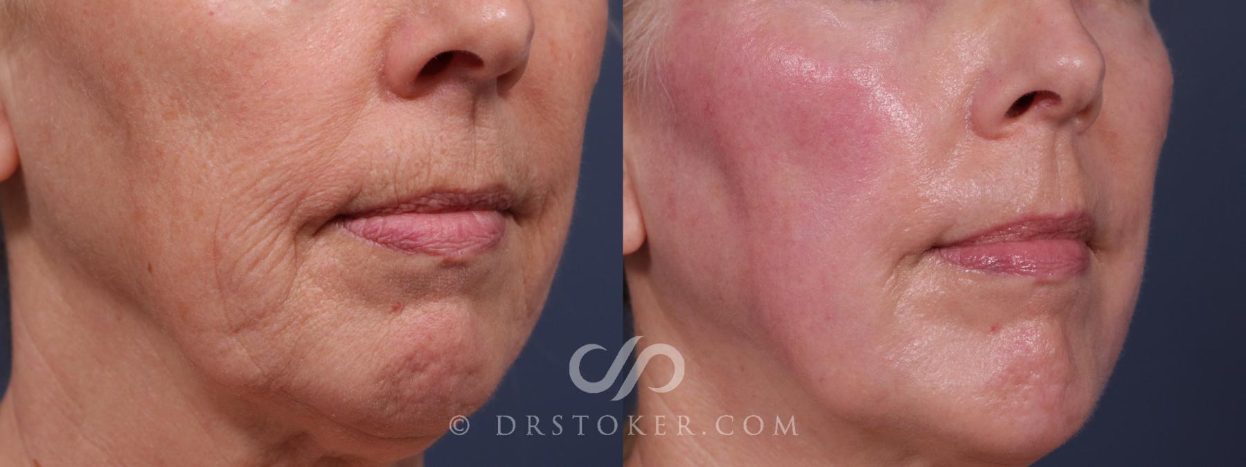 Before & After Laser Skin Resurfacing  Case 2189 Right Oblique View in Los Angeles, CA
