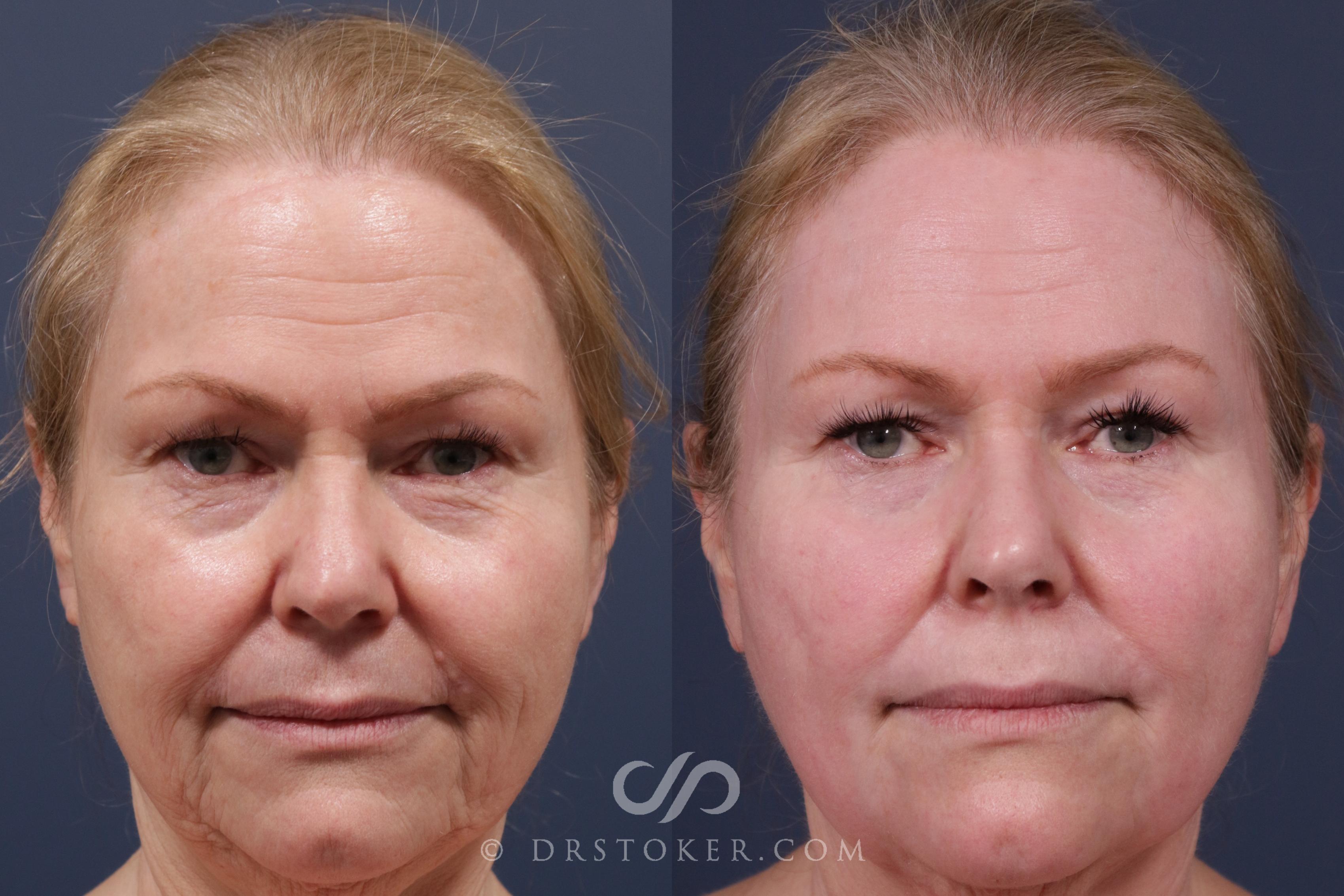 Before & After Laser Skin Resurfacing  Case 2192 Front View in Los Angeles, CA