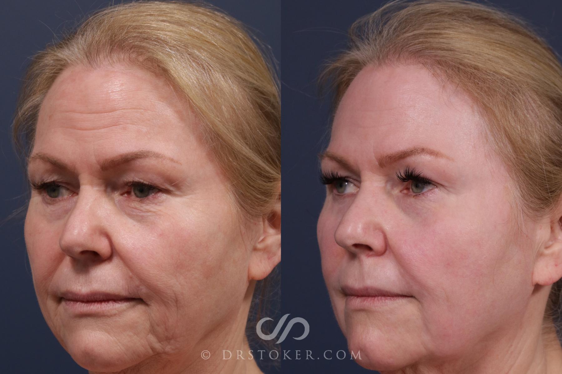 Before & After Laser Skin Resurfacing  Case 2192 Left Oblique View in Los Angeles, CA
