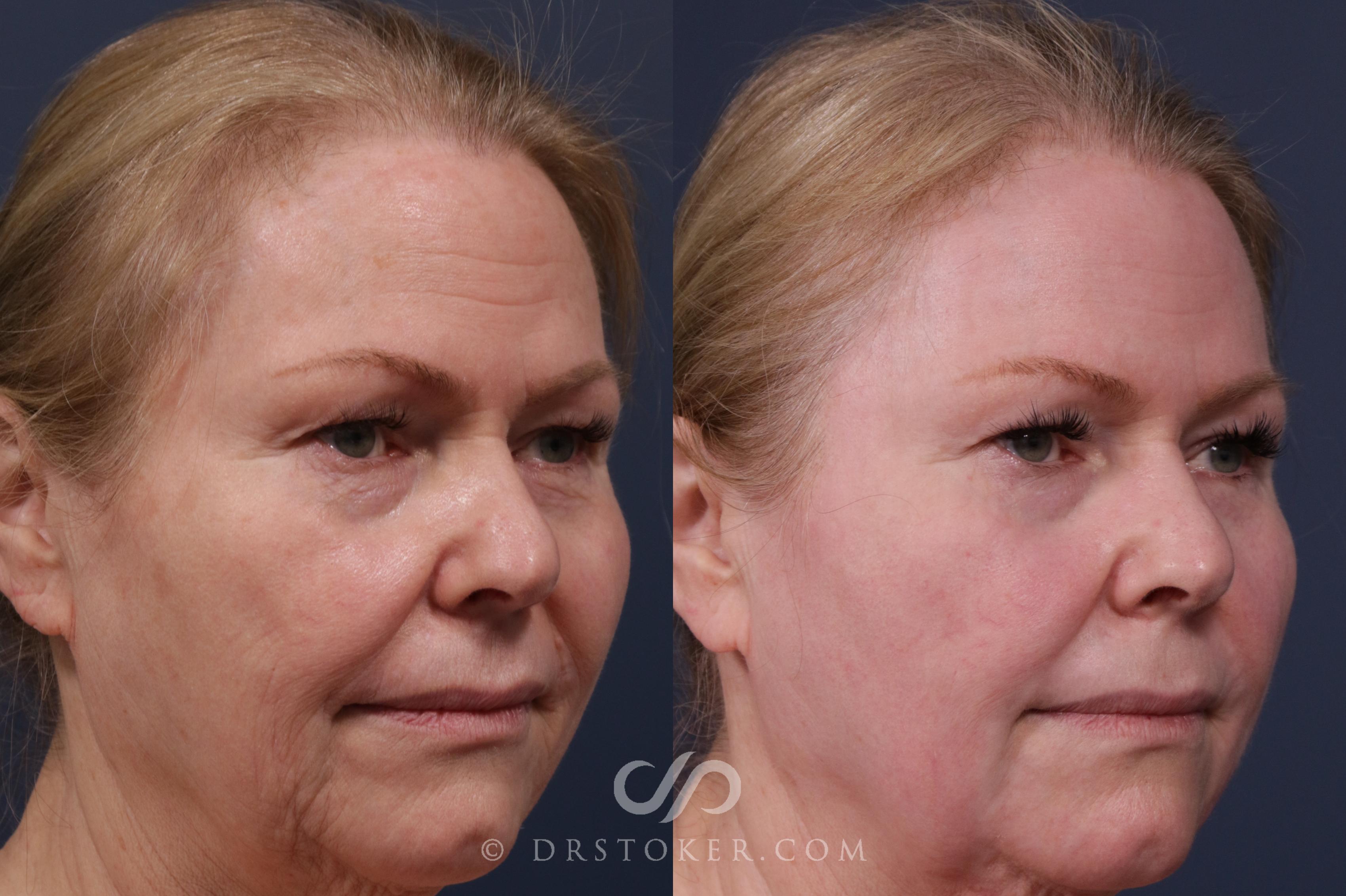 Before & After Laser Skin Resurfacing  Case 2192 Right Oblique View in Los Angeles, CA