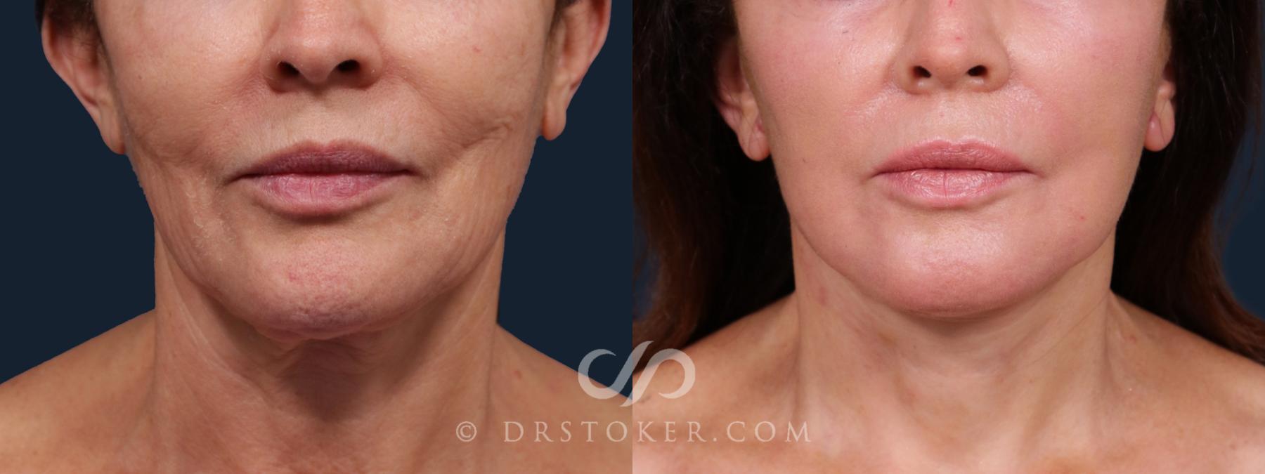 Before & After Laser Skin Resurfacing  Case 2202 Front View in Los Angeles, CA