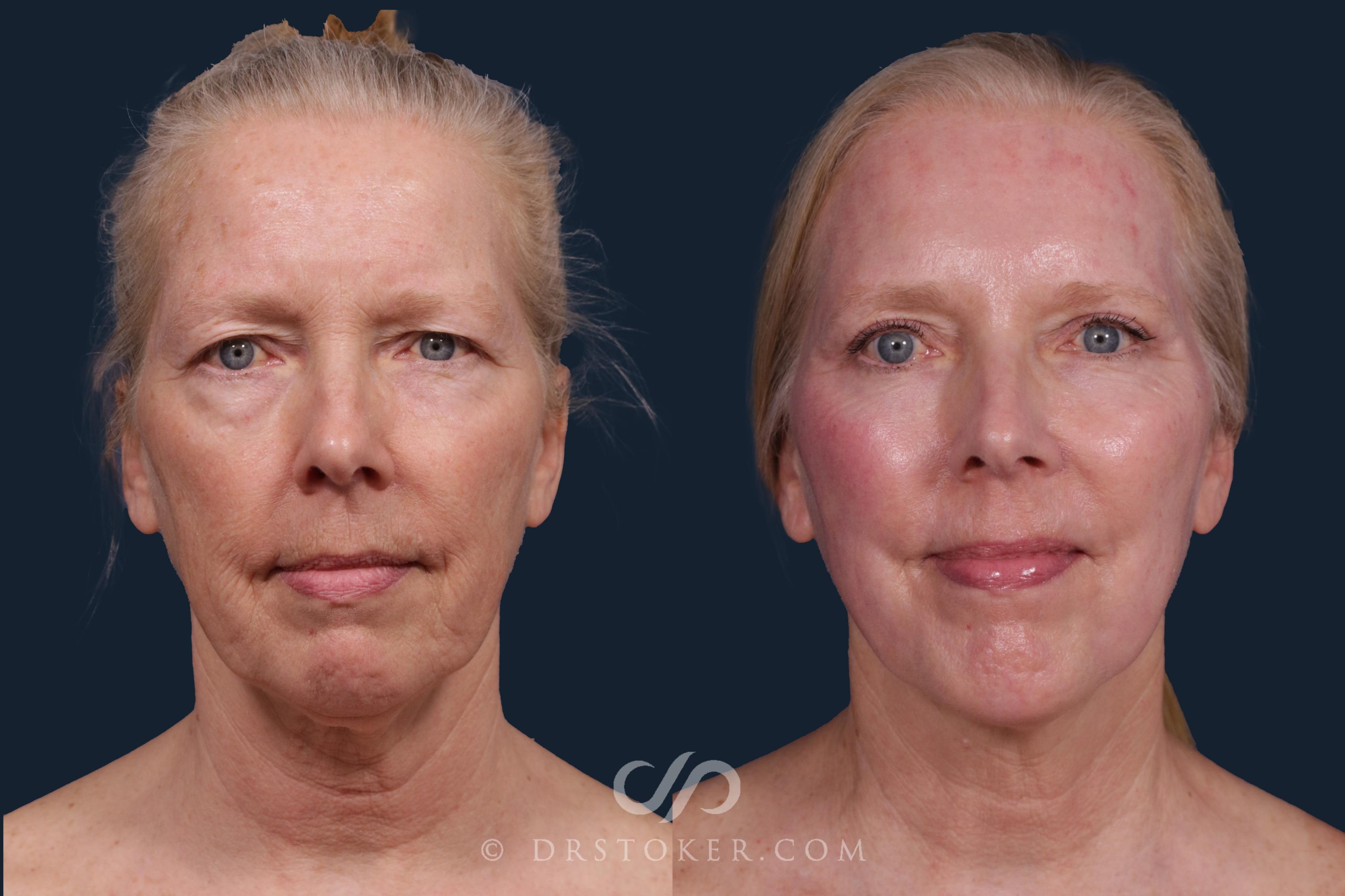 Before & After Laser Skin Resurfacing  Case 2218 Front View in Los Angeles, CA