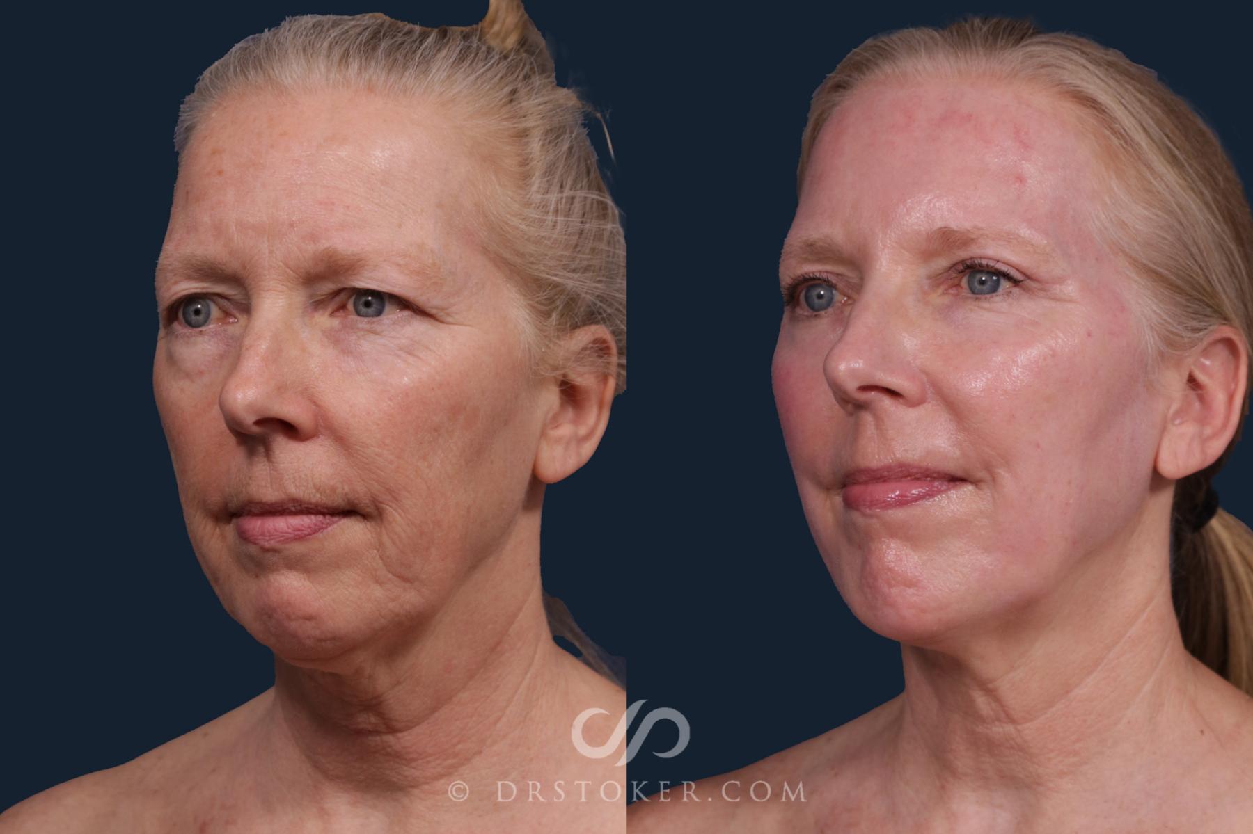 Before & After Laser Skin Resurfacing  Case 2218 Left Oblique View in Los Angeles, CA