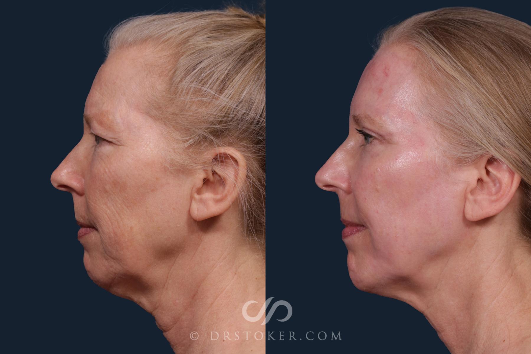 Before & After Laser Skin Resurfacing  Case 2218 Left Side View in Los Angeles, CA