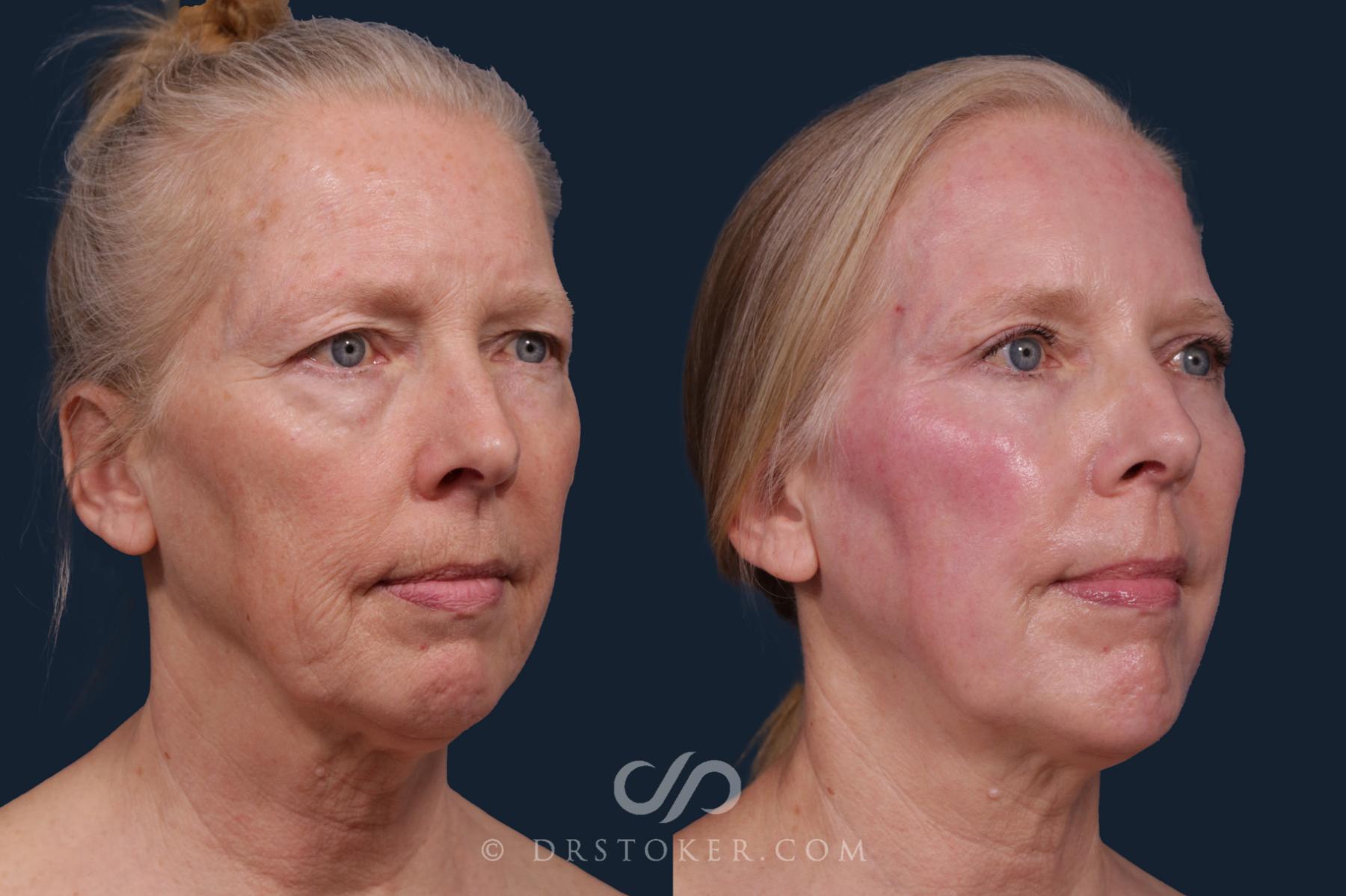 Before & After Laser Skin Resurfacing  Case 2218 Right Oblique View in Los Angeles, CA