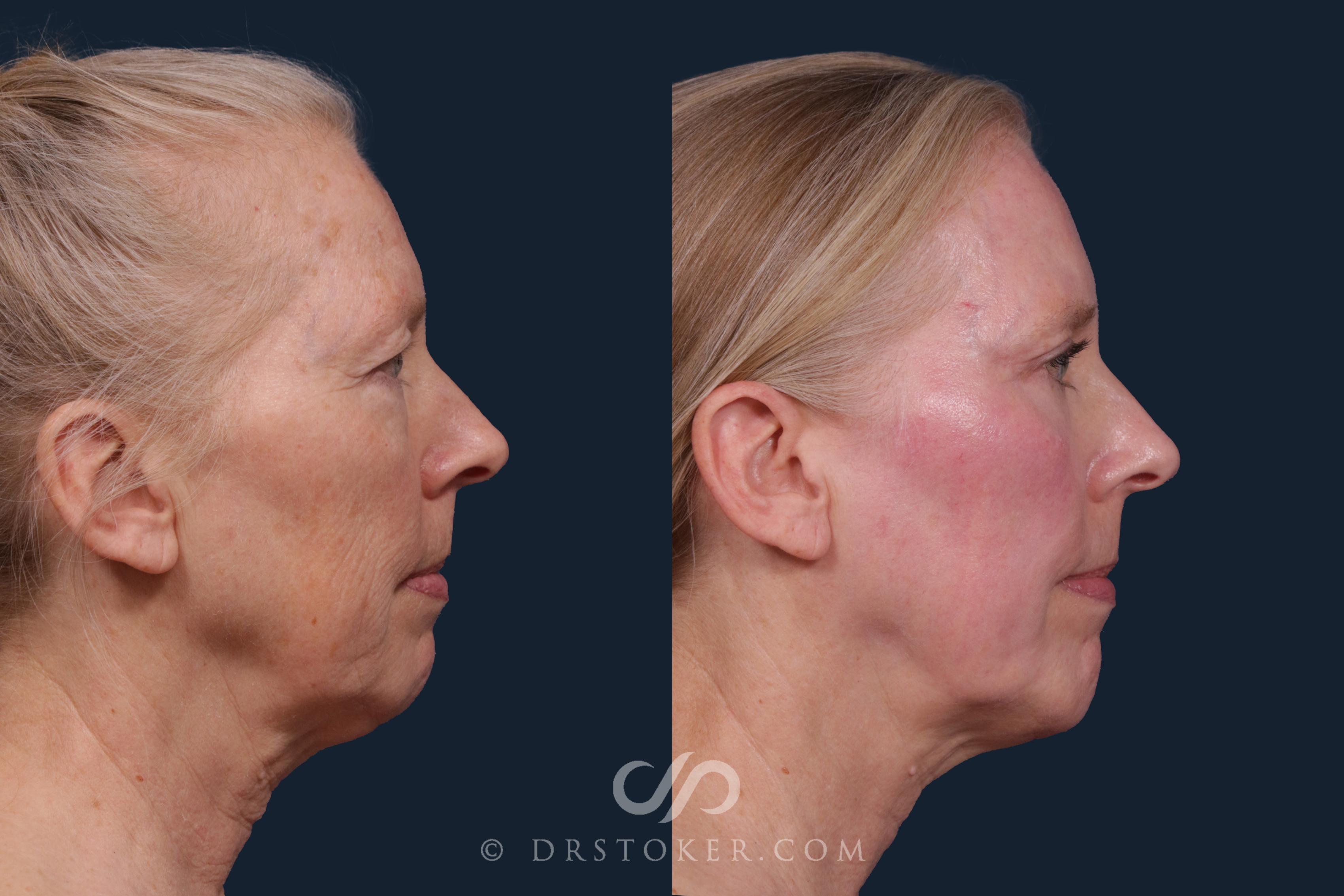 Before & After Laser Skin Resurfacing  Case 2218 Right Side View in Los Angeles, CA