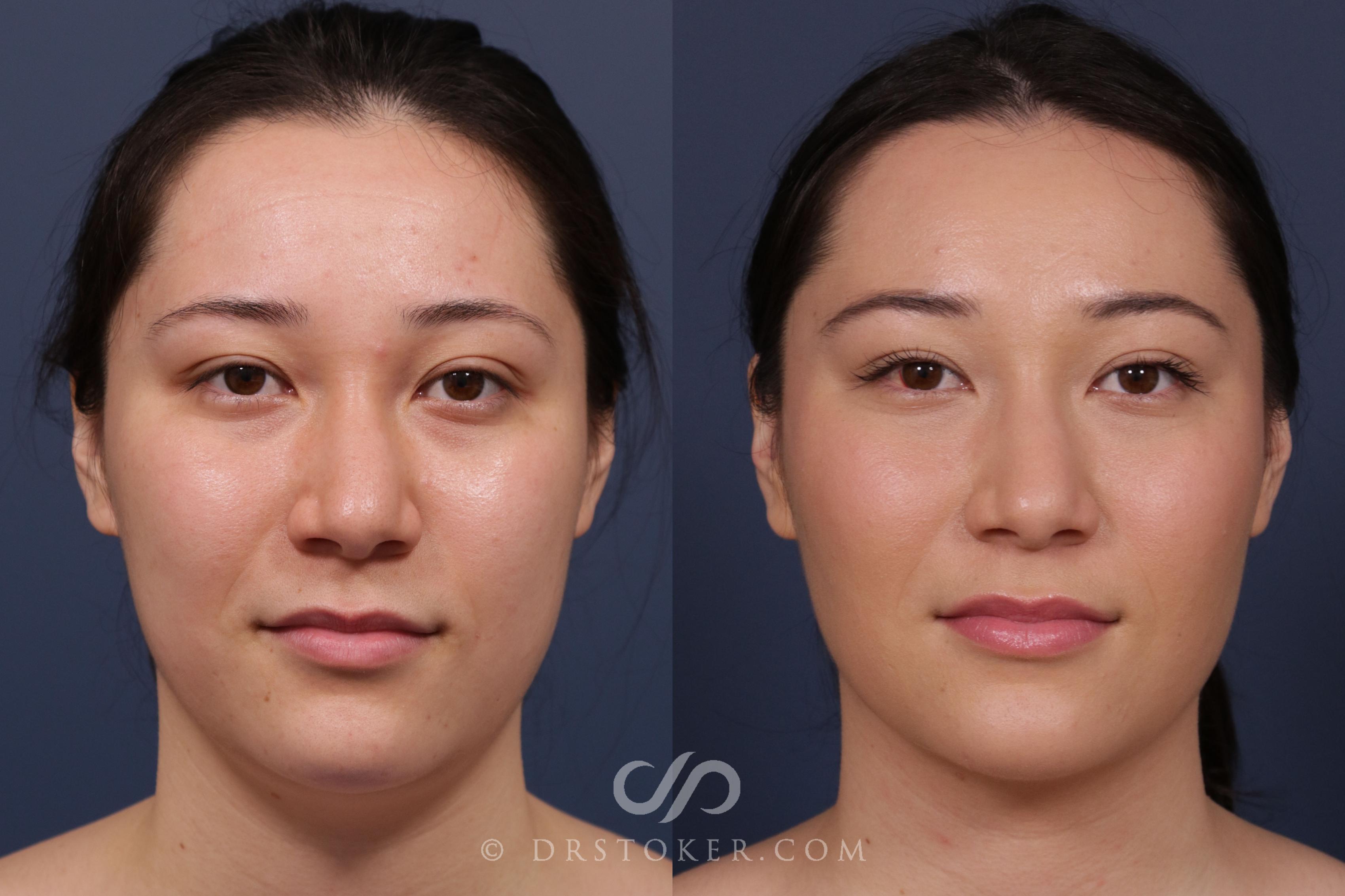Before & After Laser Resurfacing Chest Case 2037 Front View in Marina del Rey, CA