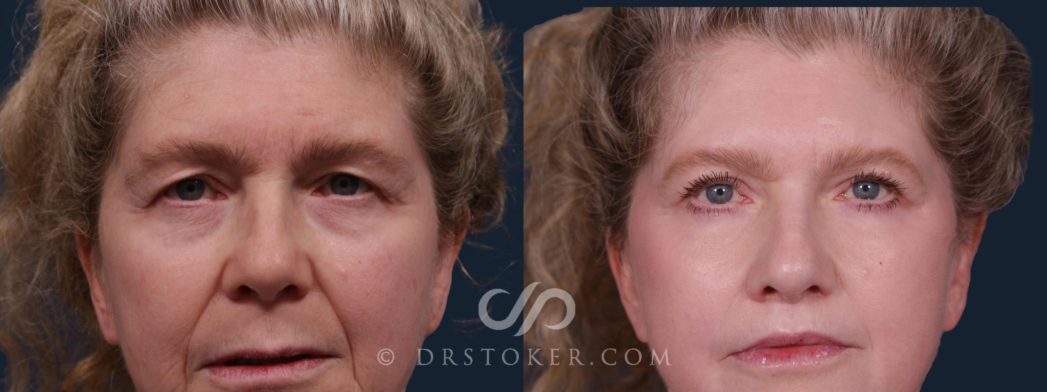 Before & After Eyelid Surgery Case 2207 Front View in Los Angeles, CA