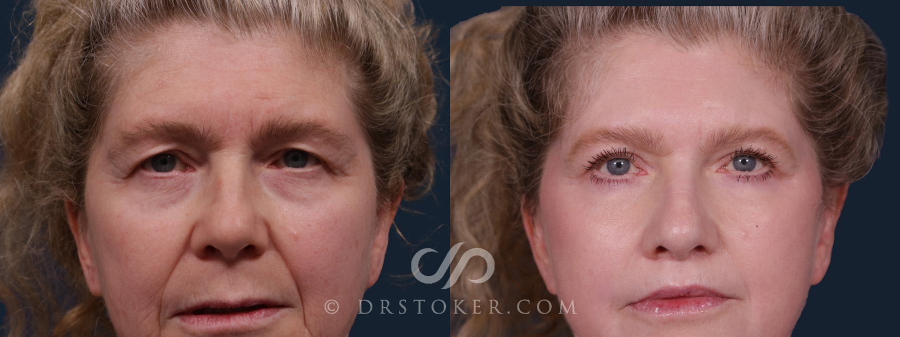 Before & After Eyelid Surgery Case 2207 Front View in Los Angeles, CA
