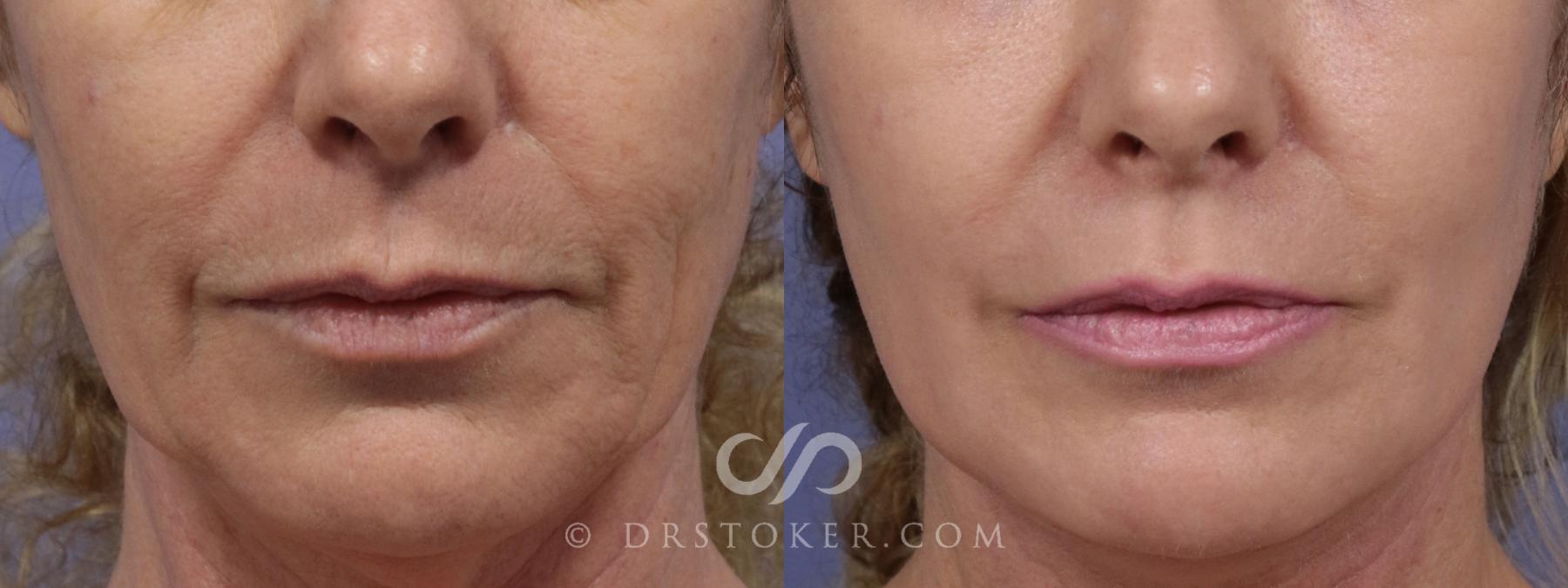 Before & After Laser Skin Resurfacing (Mouth) Case 1747 View #1 View in Los Angeles, CA