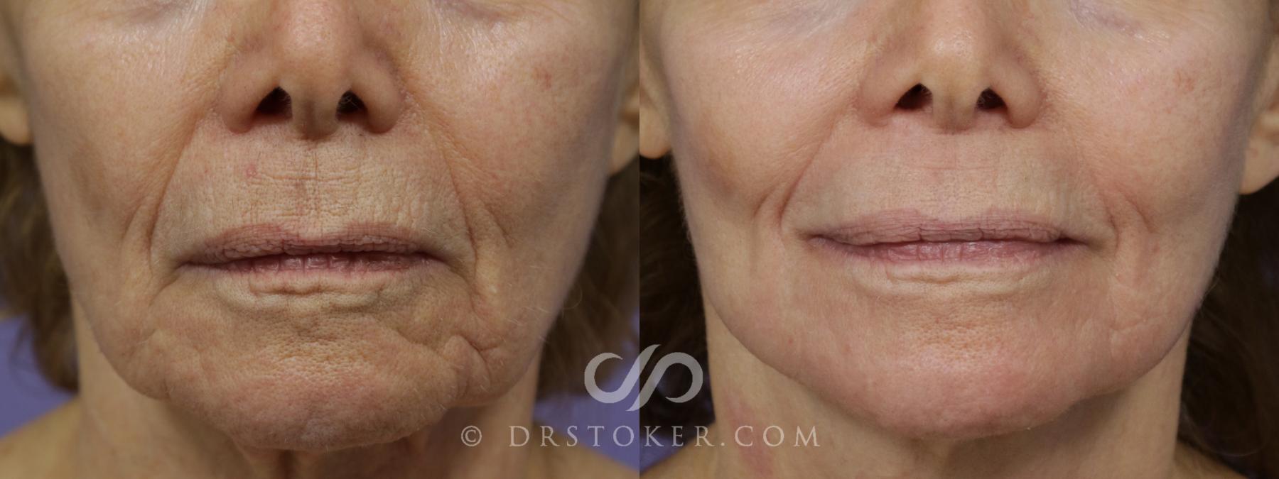 Before & After Laser Skin Resurfacing (Mouth) Case 1748 View #1 View in Los Angeles, CA