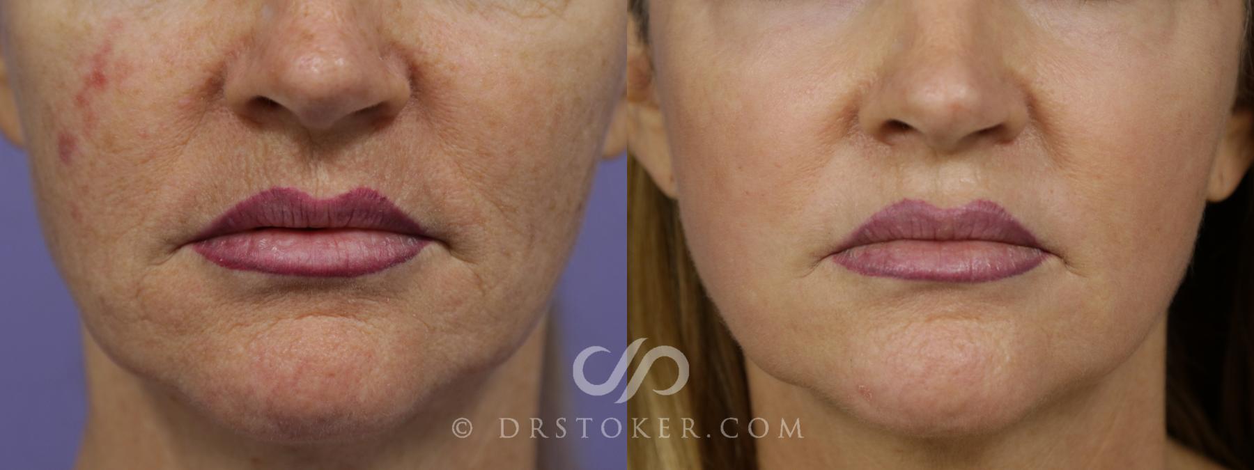 Before & After Laser Skin Resurfacing (Mouth) Case 1749 View #1 View in Los Angeles, CA