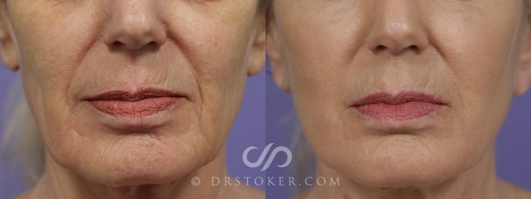 Before & After Laser Skin Resurfacing (Mouth) Case 1750 View #1 View in Los Angeles, CA