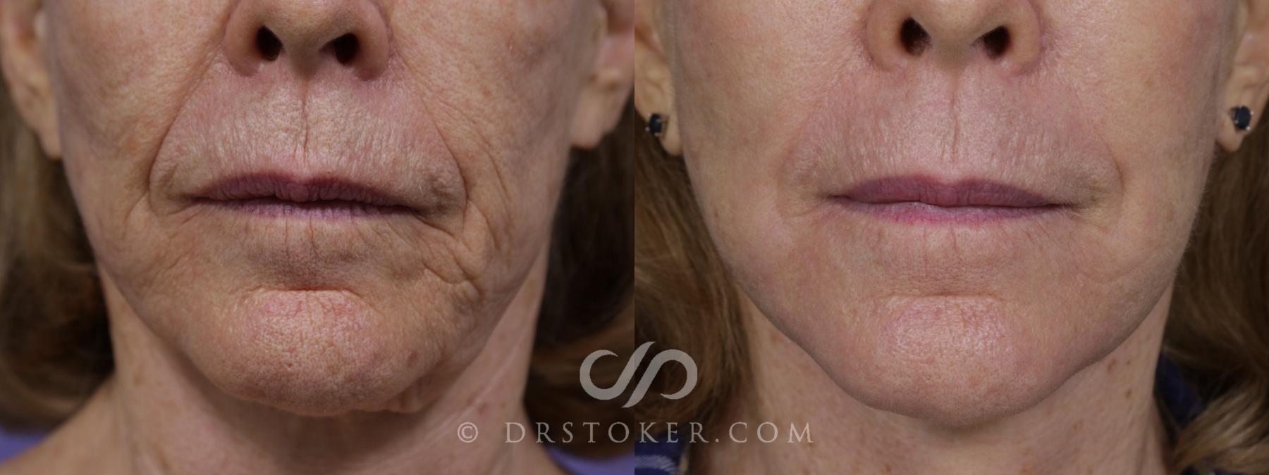 Before & After Laser Skin Resurfacing (Mouth) Case 1751 View #1 View in Los Angeles, CA