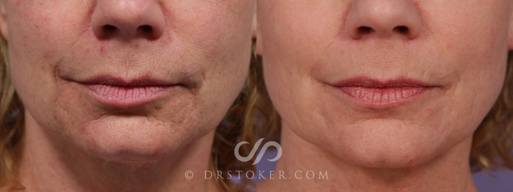 Before & After Laser Skin Resurfacing (Mouth) Case 1752 View #1 View in Los Angeles, CA