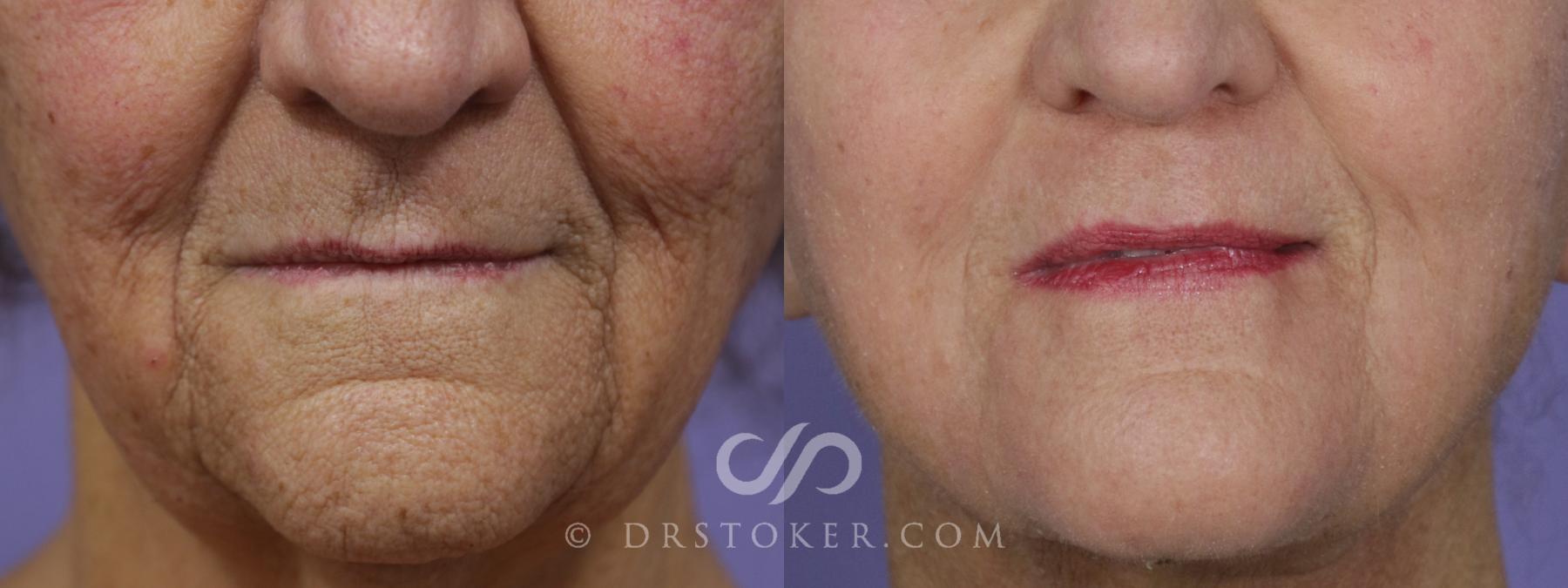 Before & After Laser Skin Resurfacing (Mouth) Case 1753 View #1 View in Los Angeles, CA