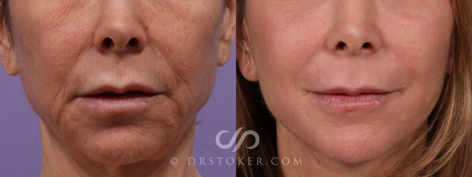 Before & After Laser Skin Resurfacing (Mouth) Case 1754 View #1 View in Los Angeles, CA
