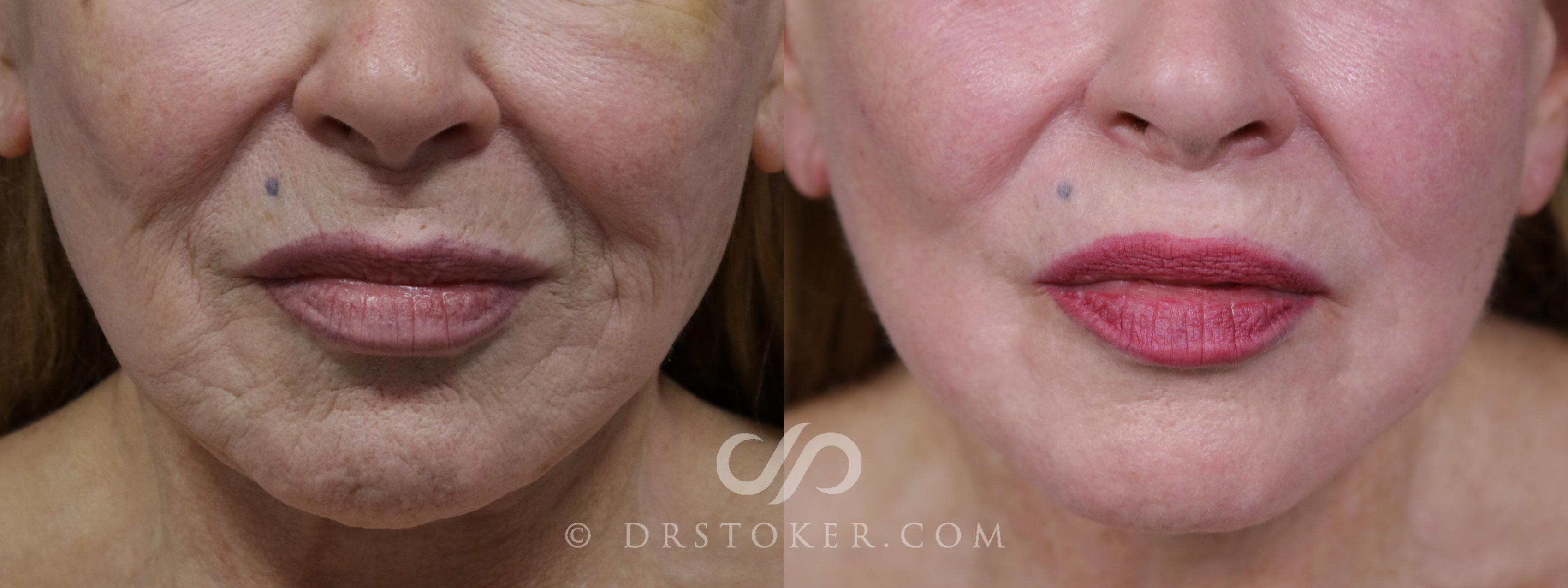 Before & After Laser Skin Resurfacing (Mouth) Case 1755 View #1 View in Los Angeles, CA