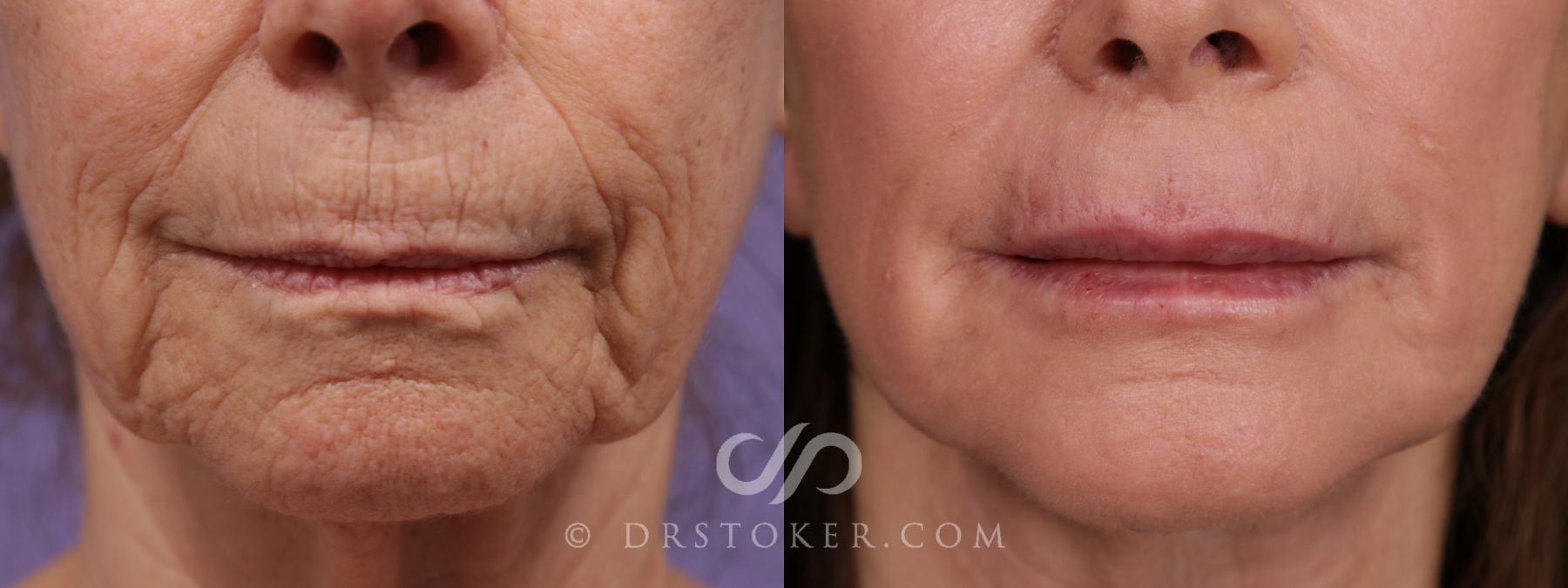Before & After Laser Skin Resurfacing (Mouth) Case 1756 View #1 View in Los Angeles, CA