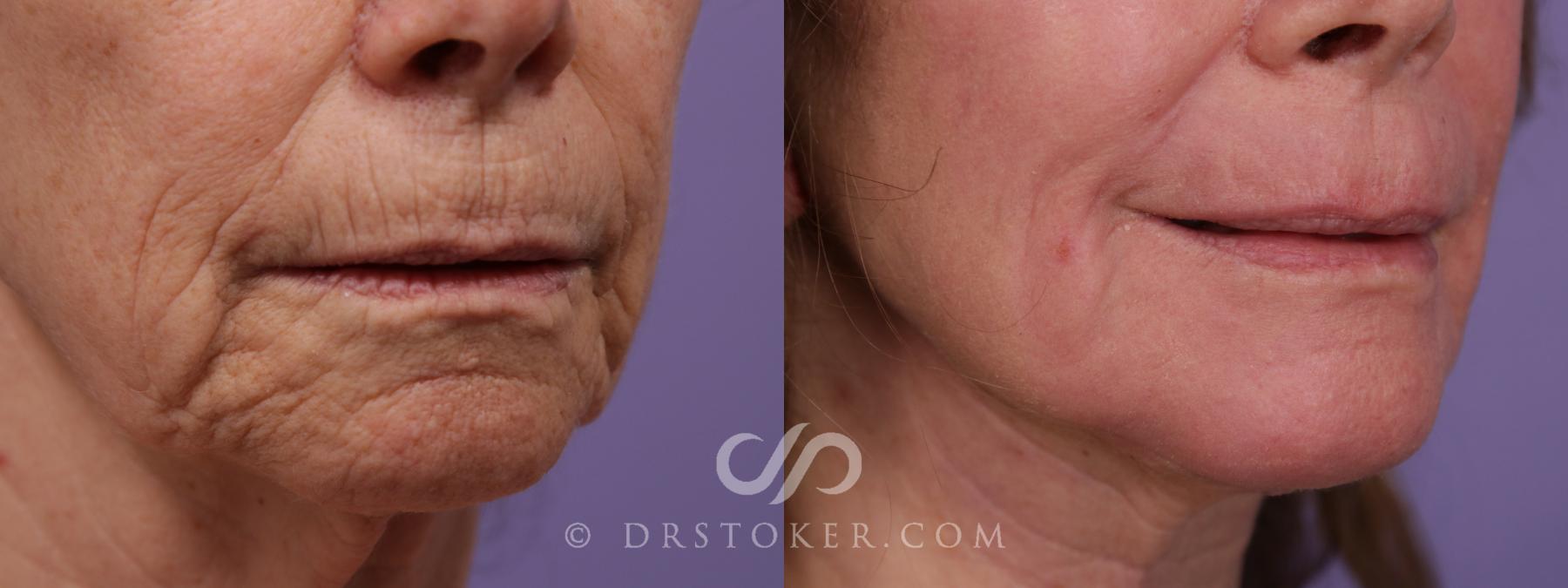 Before & After Lip Fillers/Augmentation Case 1757 View #1 View in Los Angeles, CA