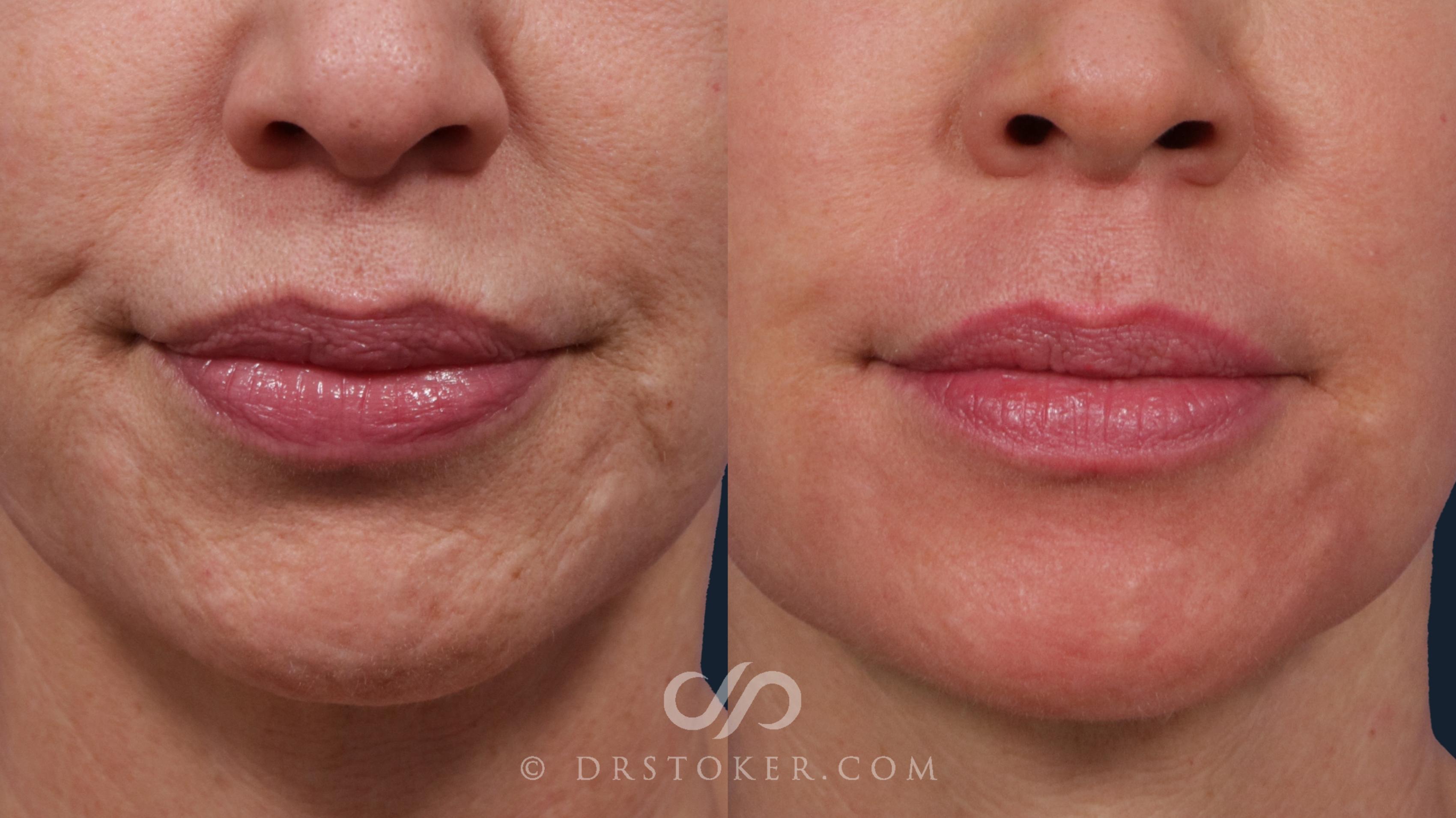 Before & After Laser Skin Resurfacing (Mouth) Case 2036 Front View in Los Angeles, CA