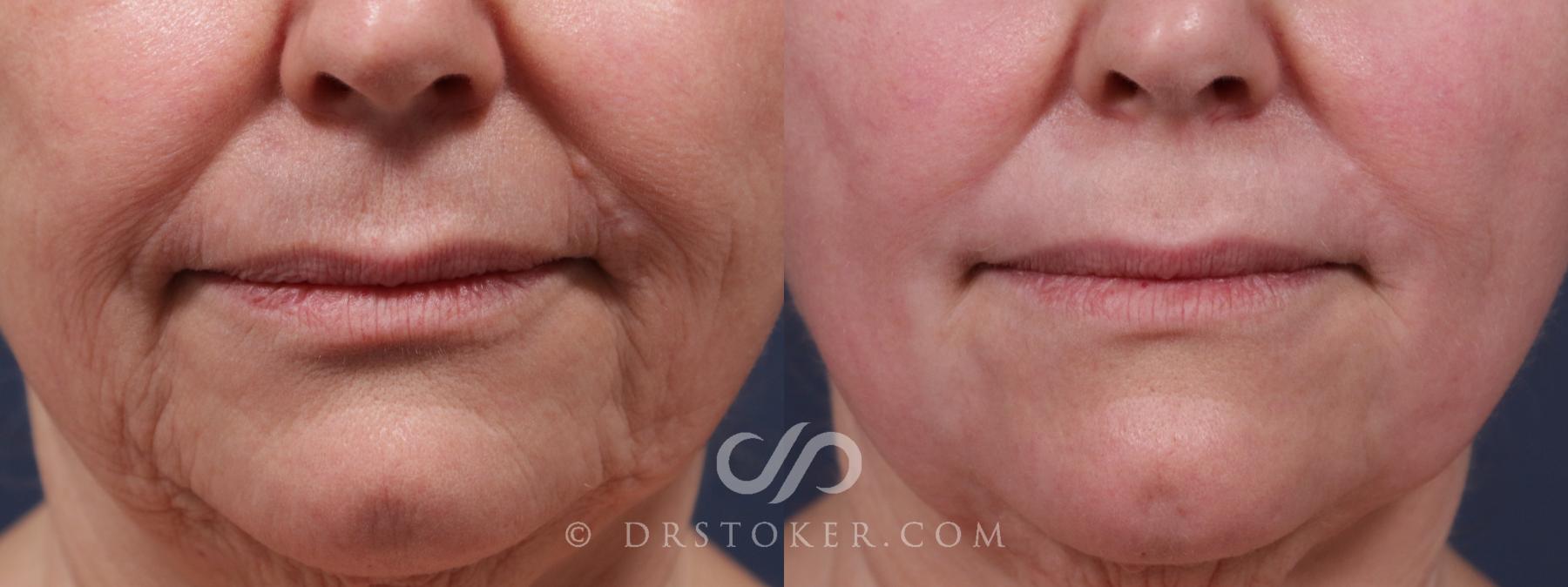 Before & After Laser Skin Resurfacing (Mouth) Case 2194 Front View in Los Angeles, CA