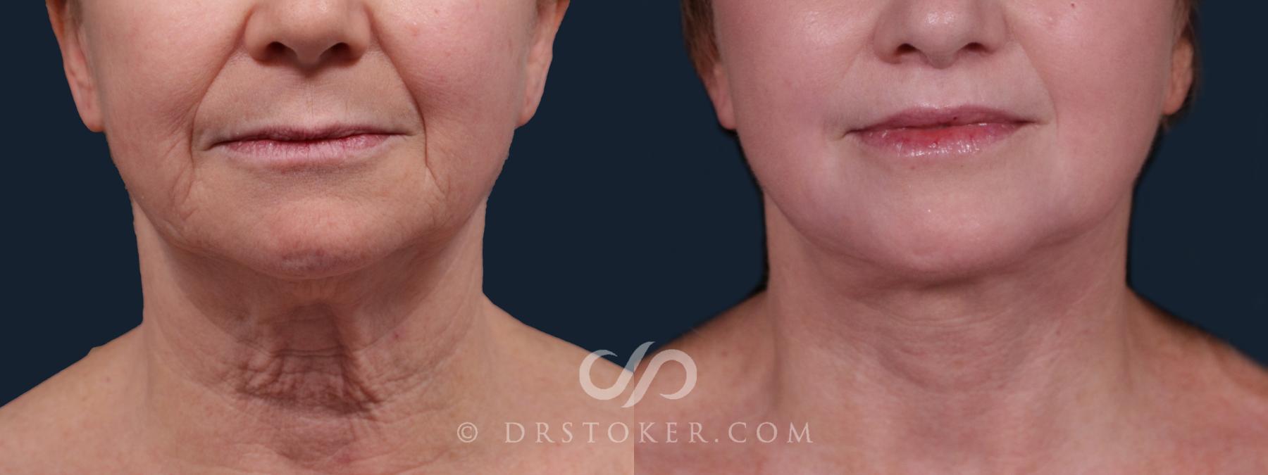 Before & After Laser Skin Resurfacing  Case 2206 Front View in Los Angeles, CA
