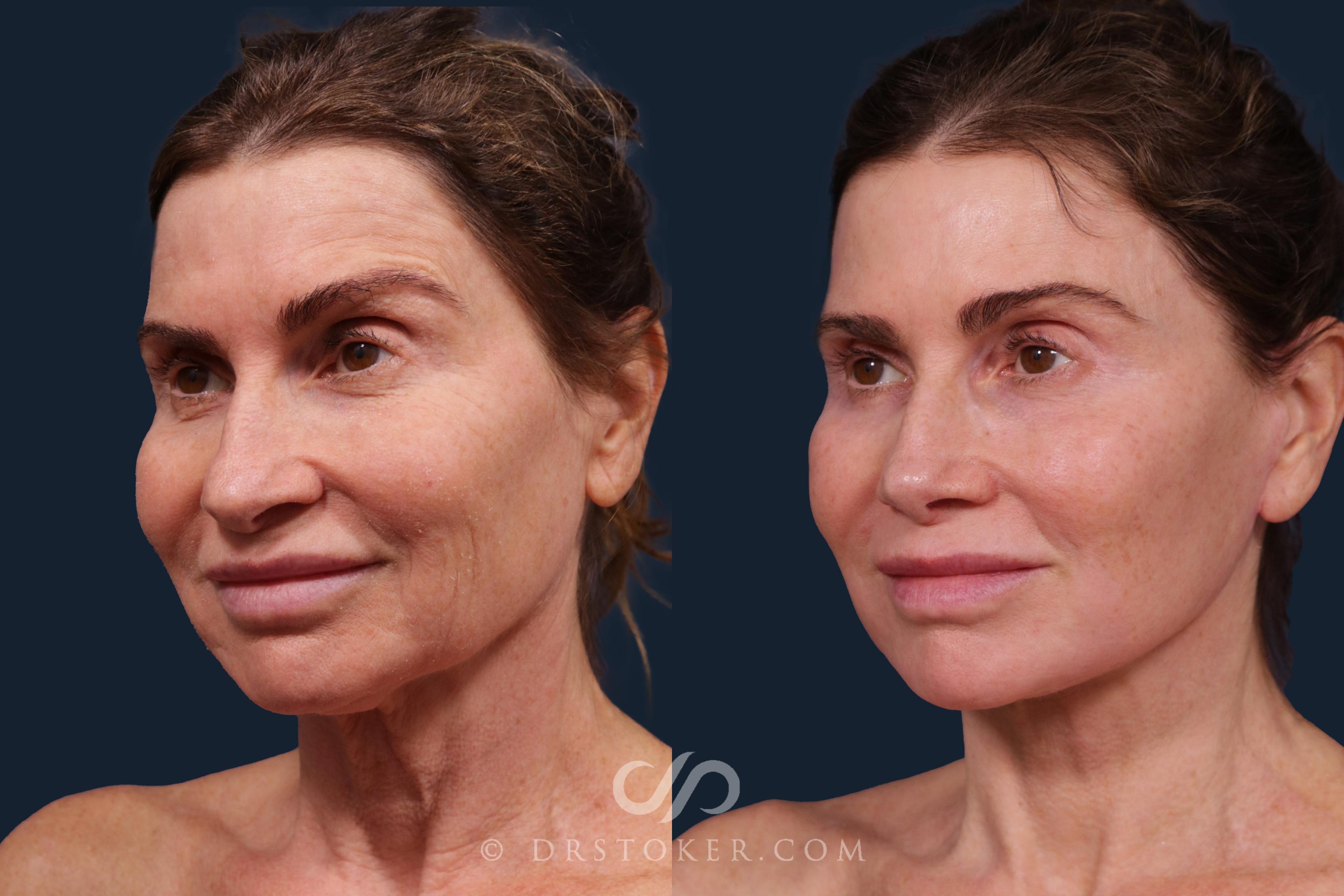 Before & After Laser Skin Resurfacing  Case 2227 Left Oblique View in Los Angeles, CA