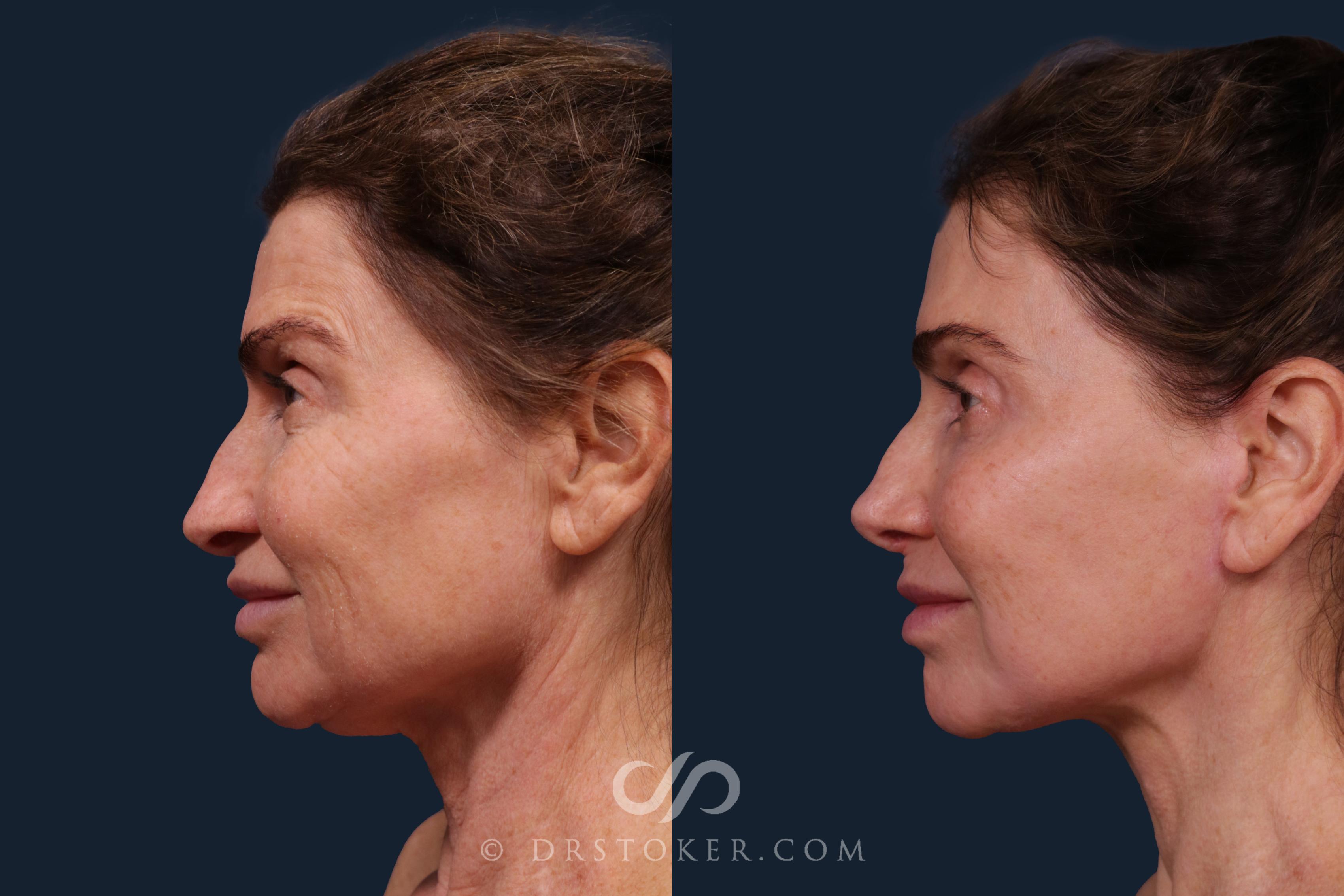 Before & After Laser Skin Resurfacing  Case 2227 Left Side View in Los Angeles, CA