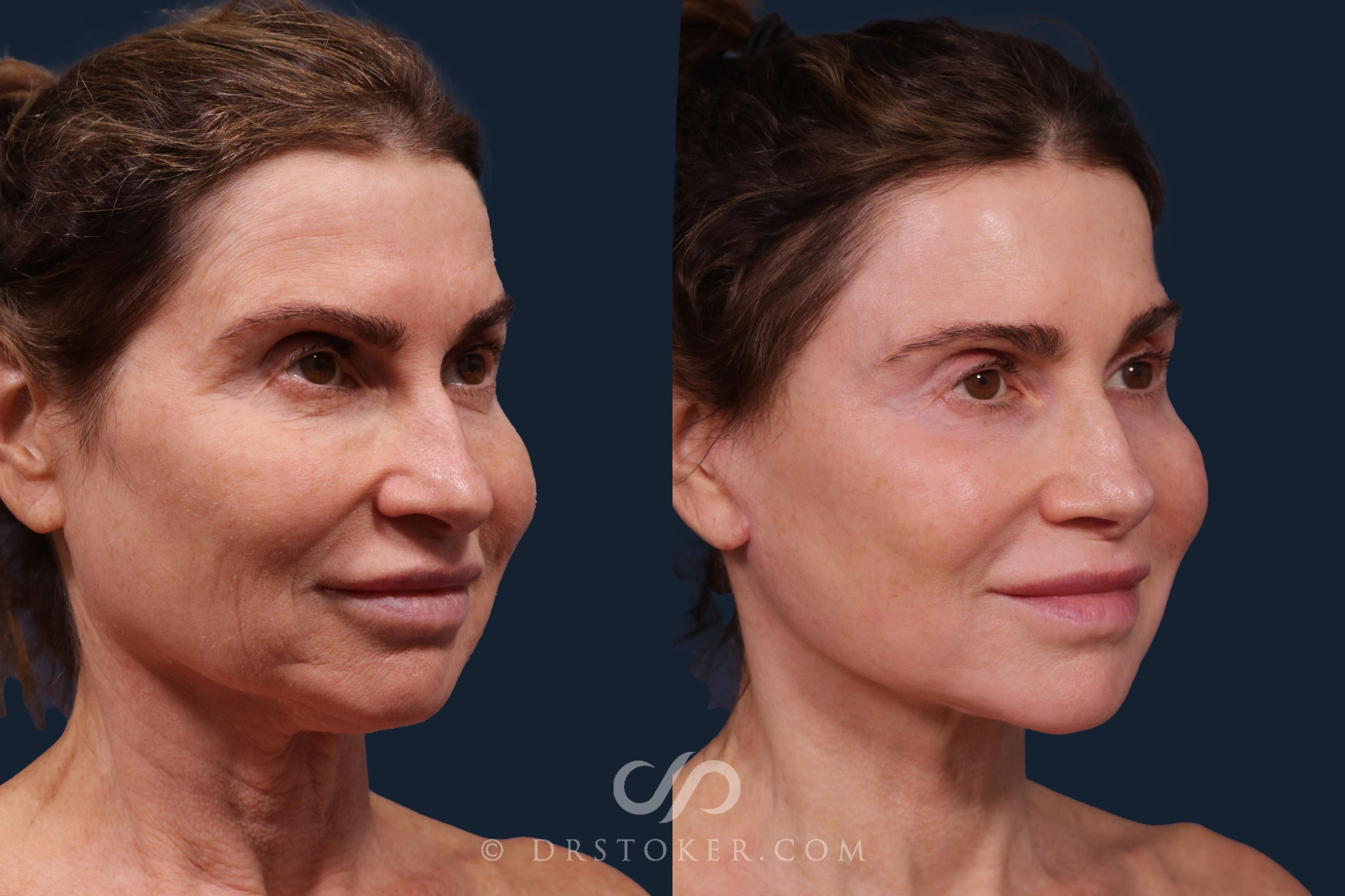 Before & After Laser Skin Resurfacing  Case 2227 Right Oblique View in Los Angeles, CA