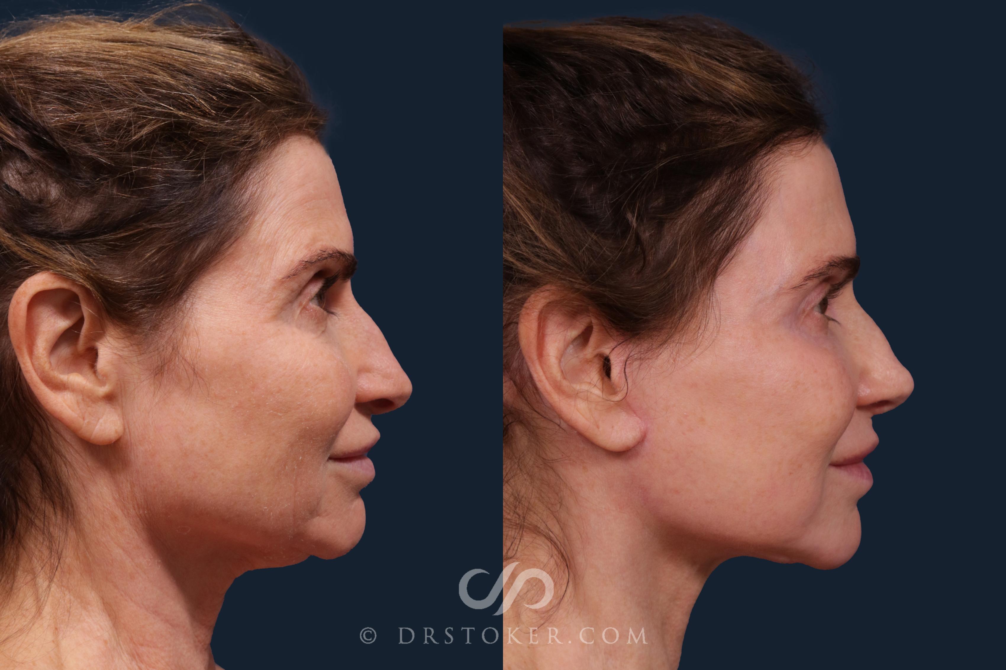 Before & After Laser Skin Resurfacing  Case 2227 Right Side View in Los Angeles, CA