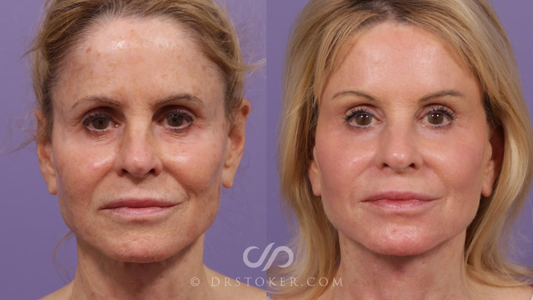 Before & After Laser Skin Resurfacing  Case 2298 Front View in Los Angeles, CA