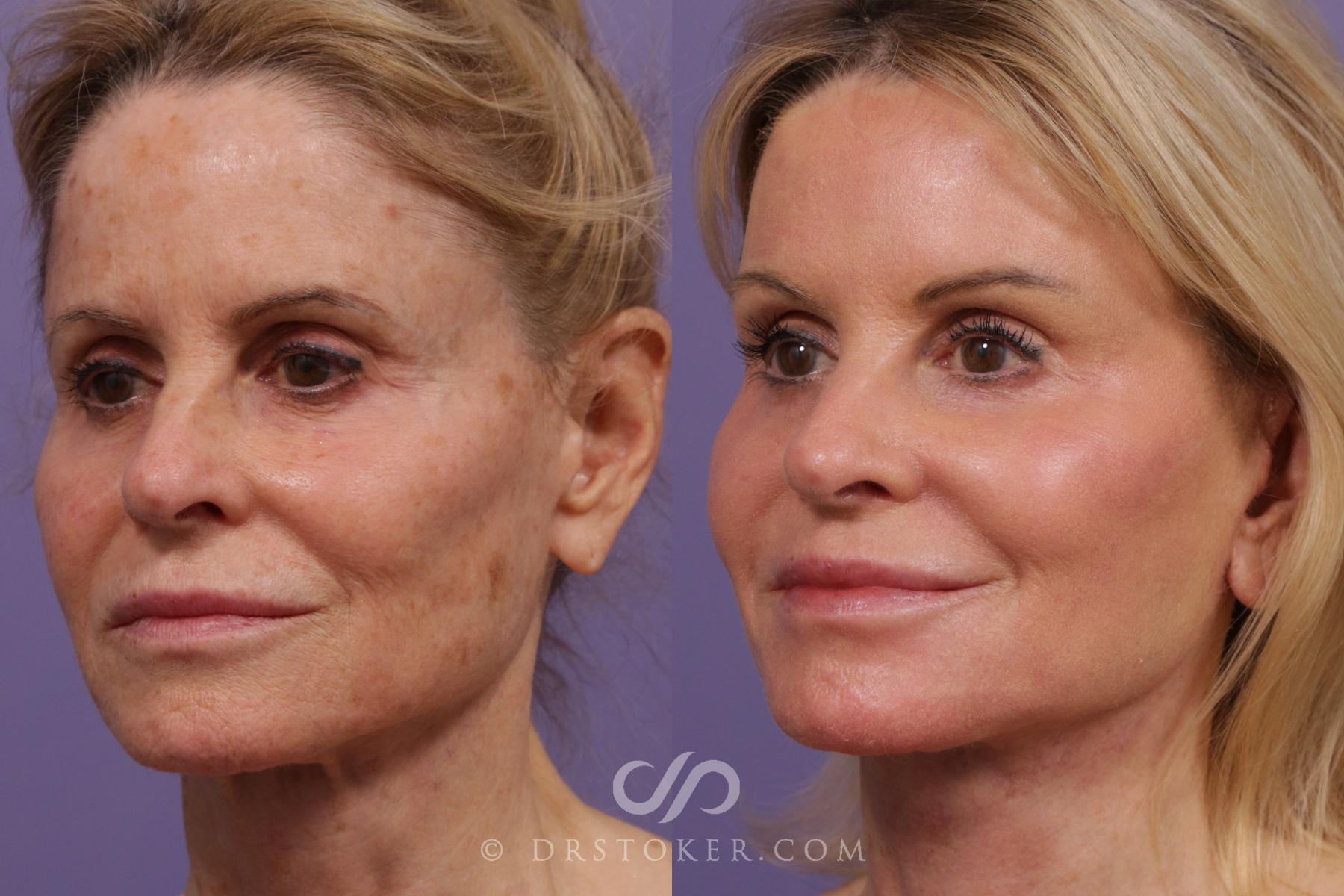 Before & After Laser Skin Resurfacing  Case 2298 Left Oblique View in Los Angeles, CA