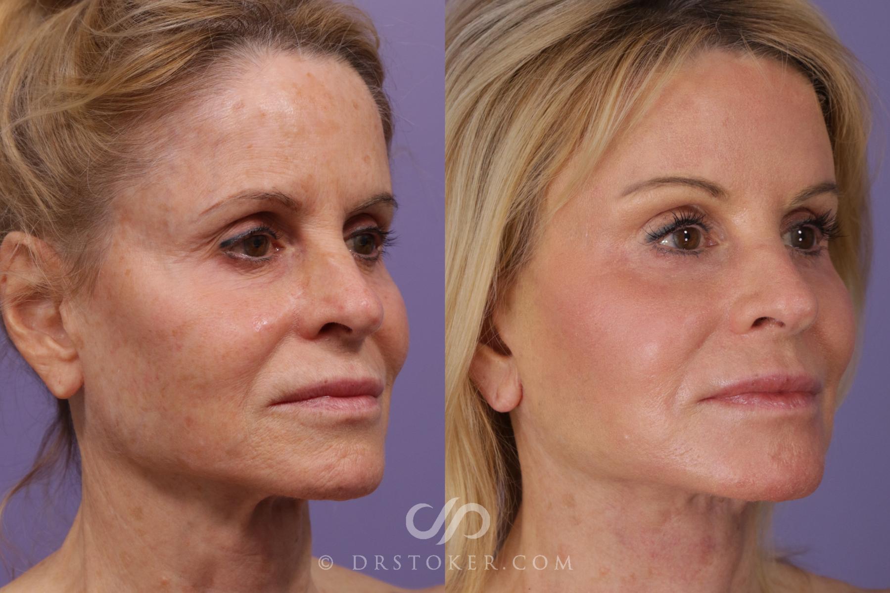 Before & After Laser Skin Resurfacing  Case 2298 Right Oblique View in Los Angeles, CA