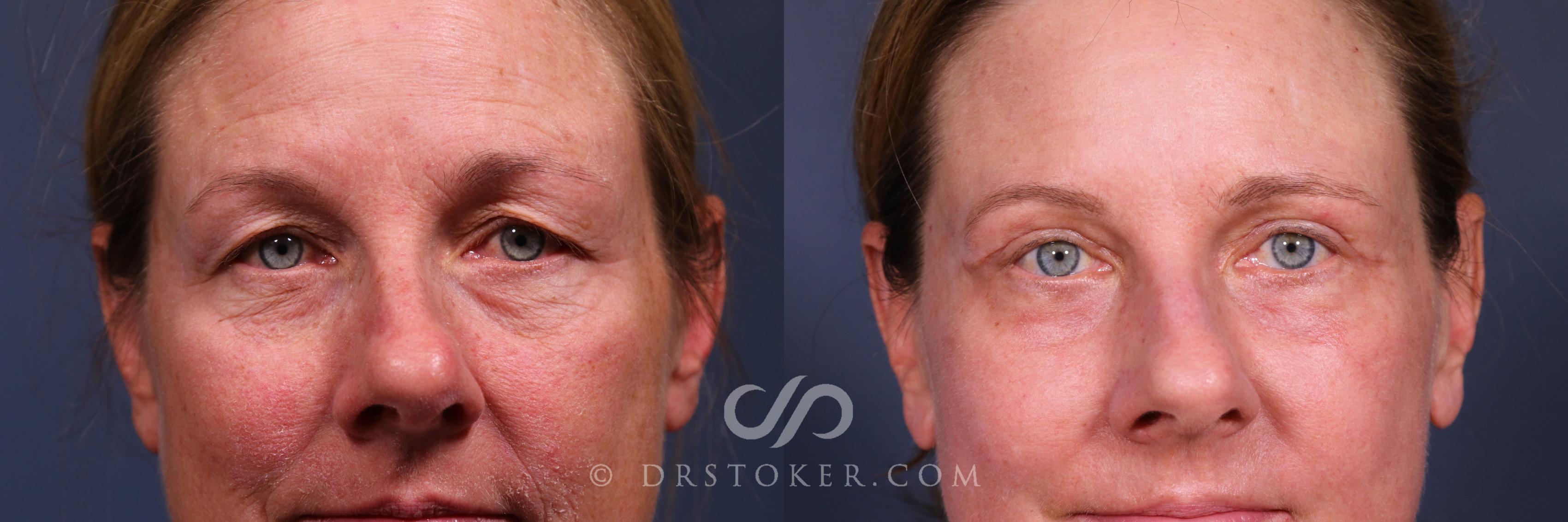 Before & After Laser Skin Resurfacing  Case 2560 Front Eyes View in Los Angeles, CA
