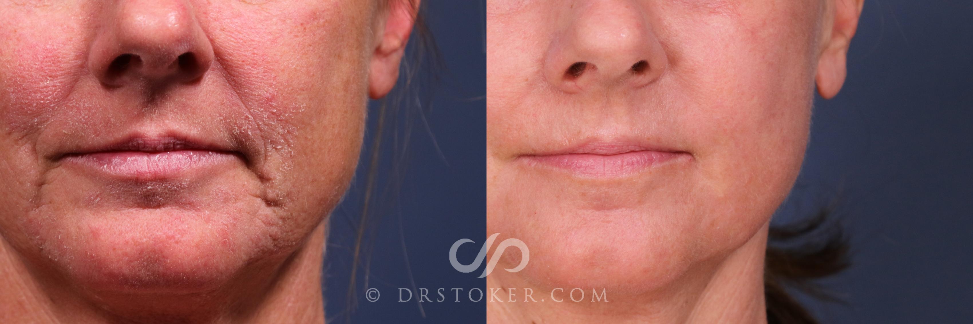 Before & After Laser Skin Resurfacing  Case 2560 front left tight View in Los Angeles, CA