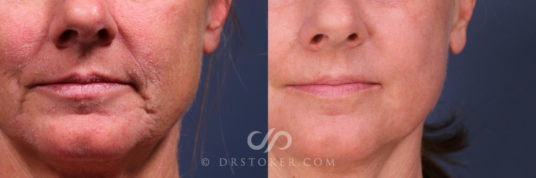 Before & After Laser Skin Resurfacing  Case 2560 front left tight View in Los Angeles, CA