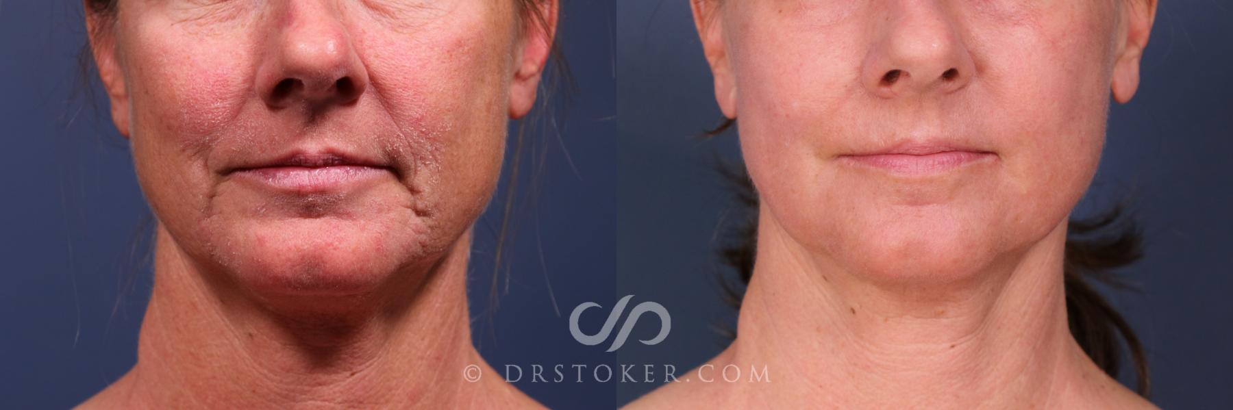 Before & After Laser Skin Resurfacing  Case 2560 Front View in Los Angeles, CA