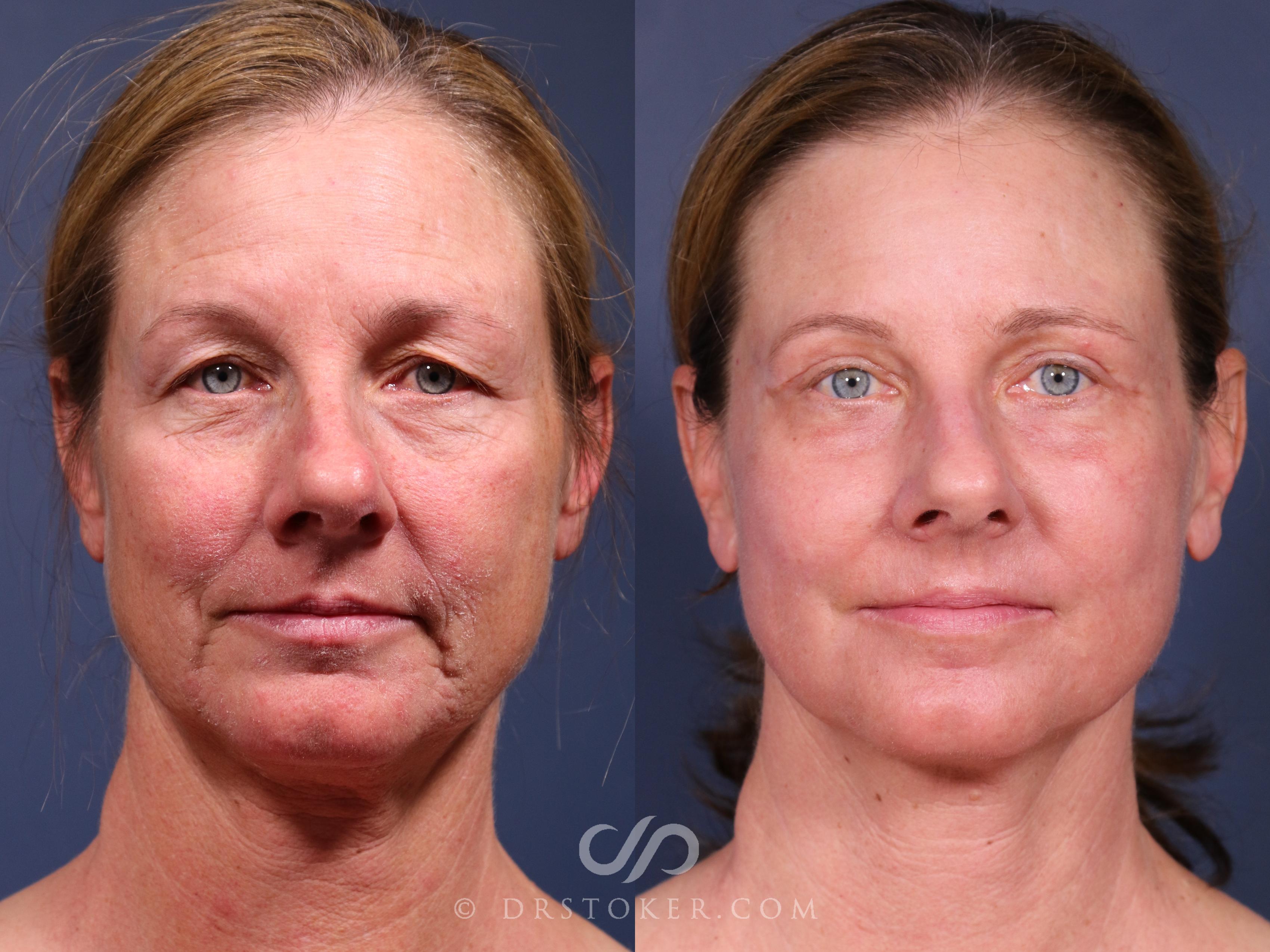 Before & After Laser Skin Resurfacing  Case 2560 Full Front View in Los Angeles, CA