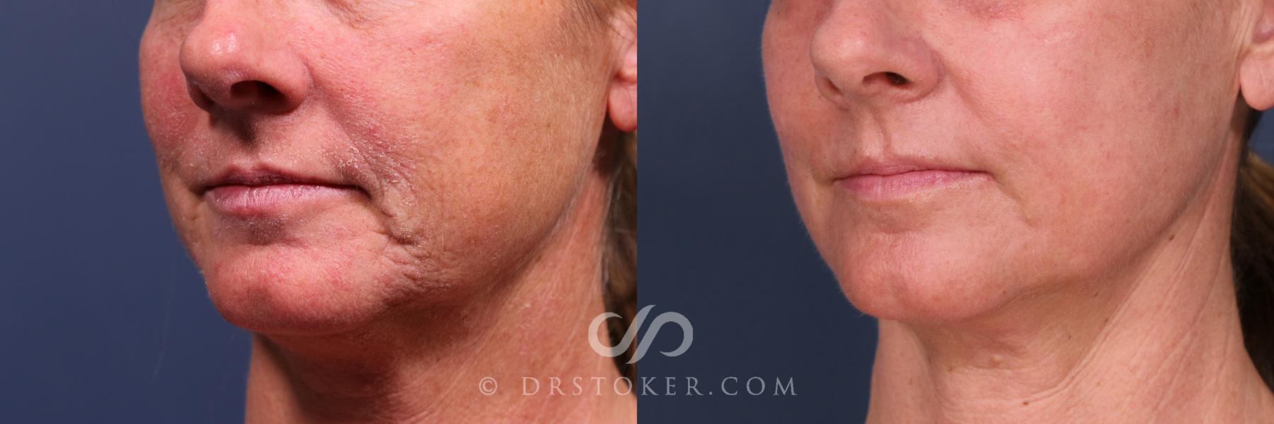 Before & After Laser Skin Resurfacing  Case 2560 Left Oblique View in Los Angeles, CA