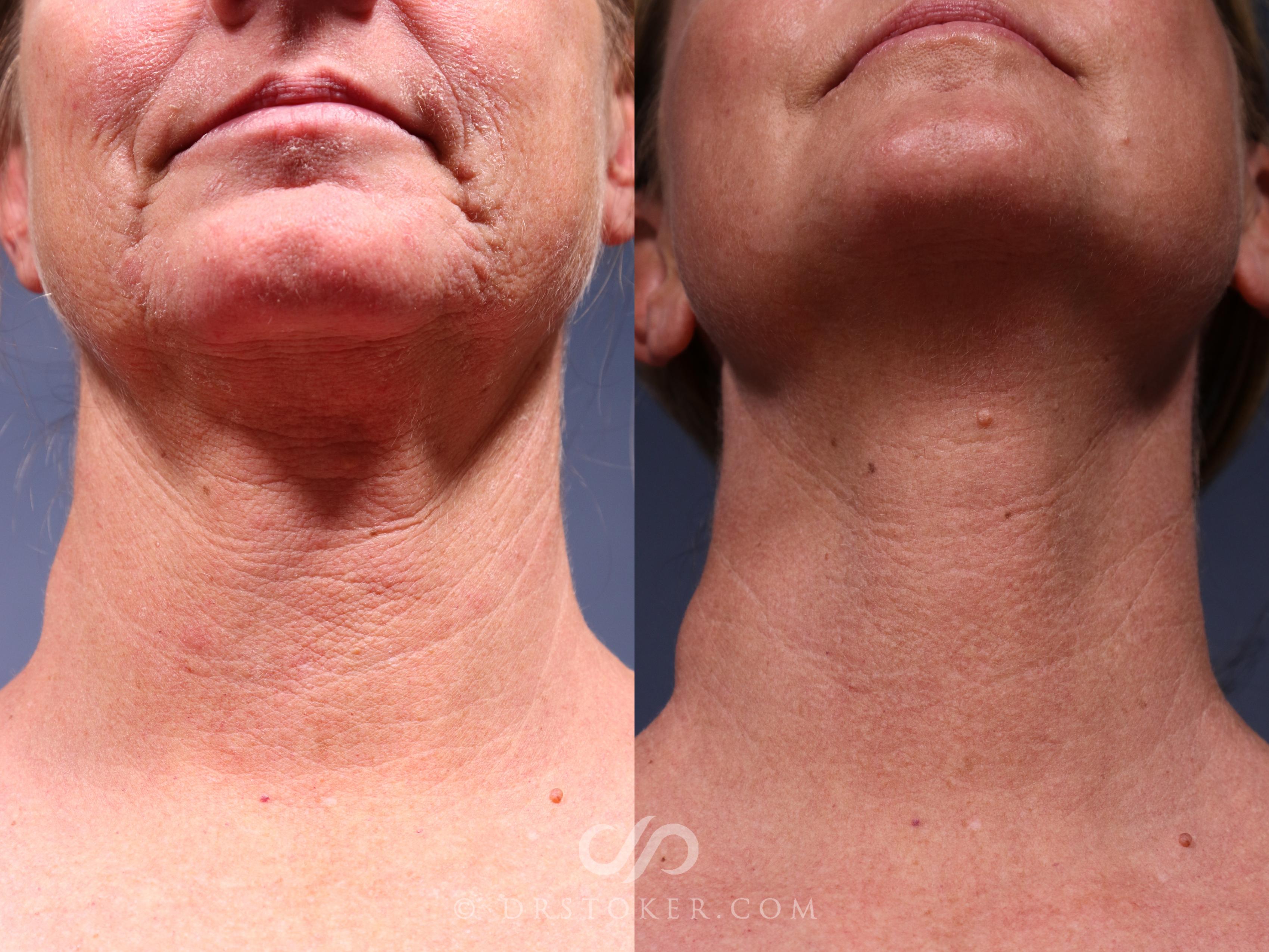 Before & After Laser Skin Resurfacing  Case 2560 Neck View in Los Angeles, CA