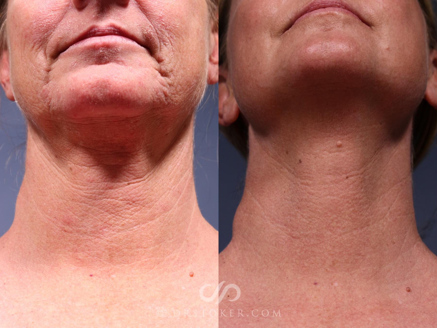 Before & After Laser Skin Resurfacing  Case 2560 Neck View in Los Angeles, CA