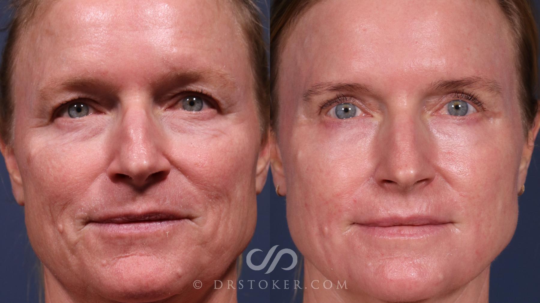 Before & After Laser Skin Resurfacing  Case 2561 Front View in Los Angeles, CA