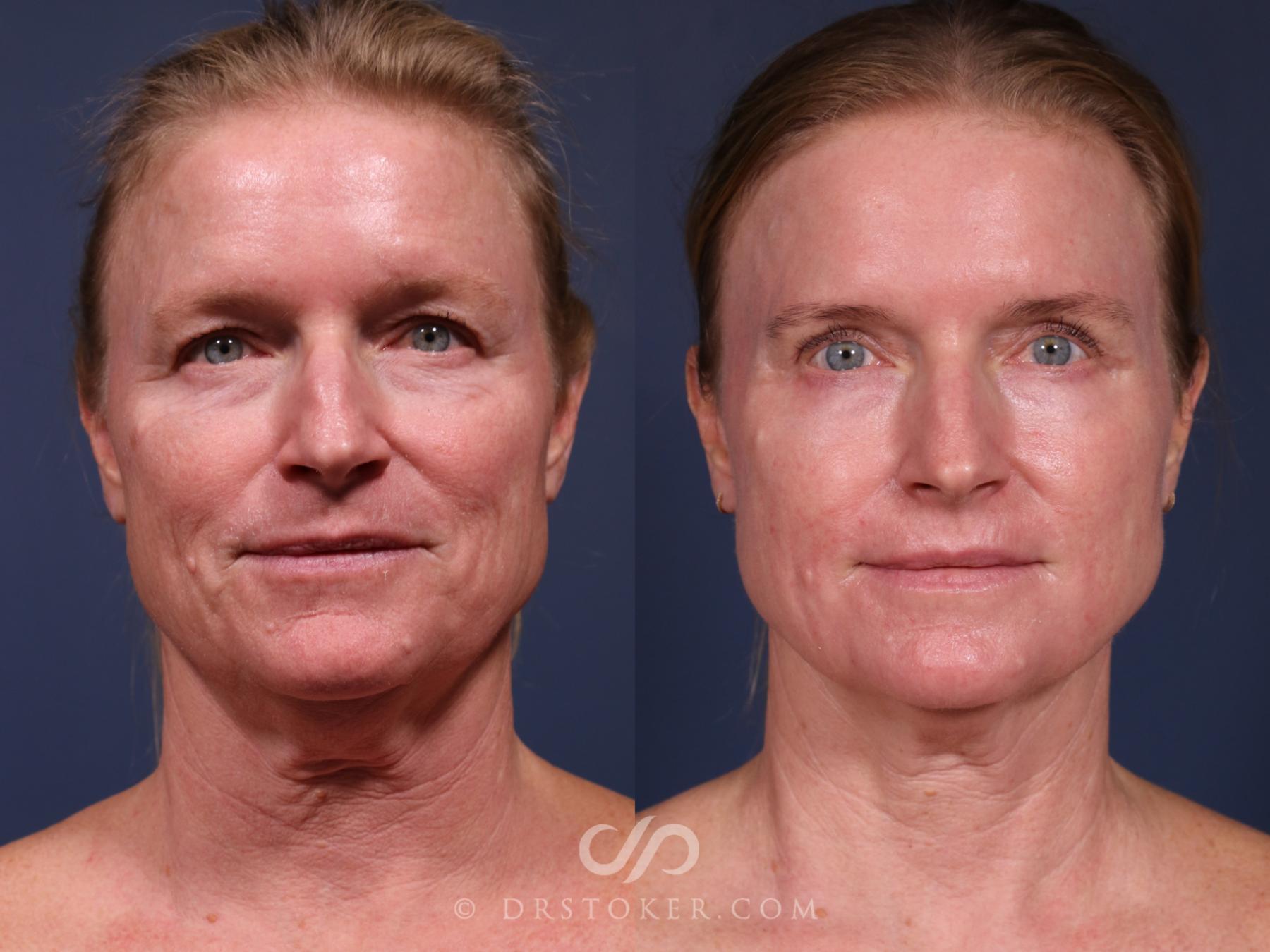 Before & After Laser Skin Resurfacing  Case 2561 Full Face View in Los Angeles, CA