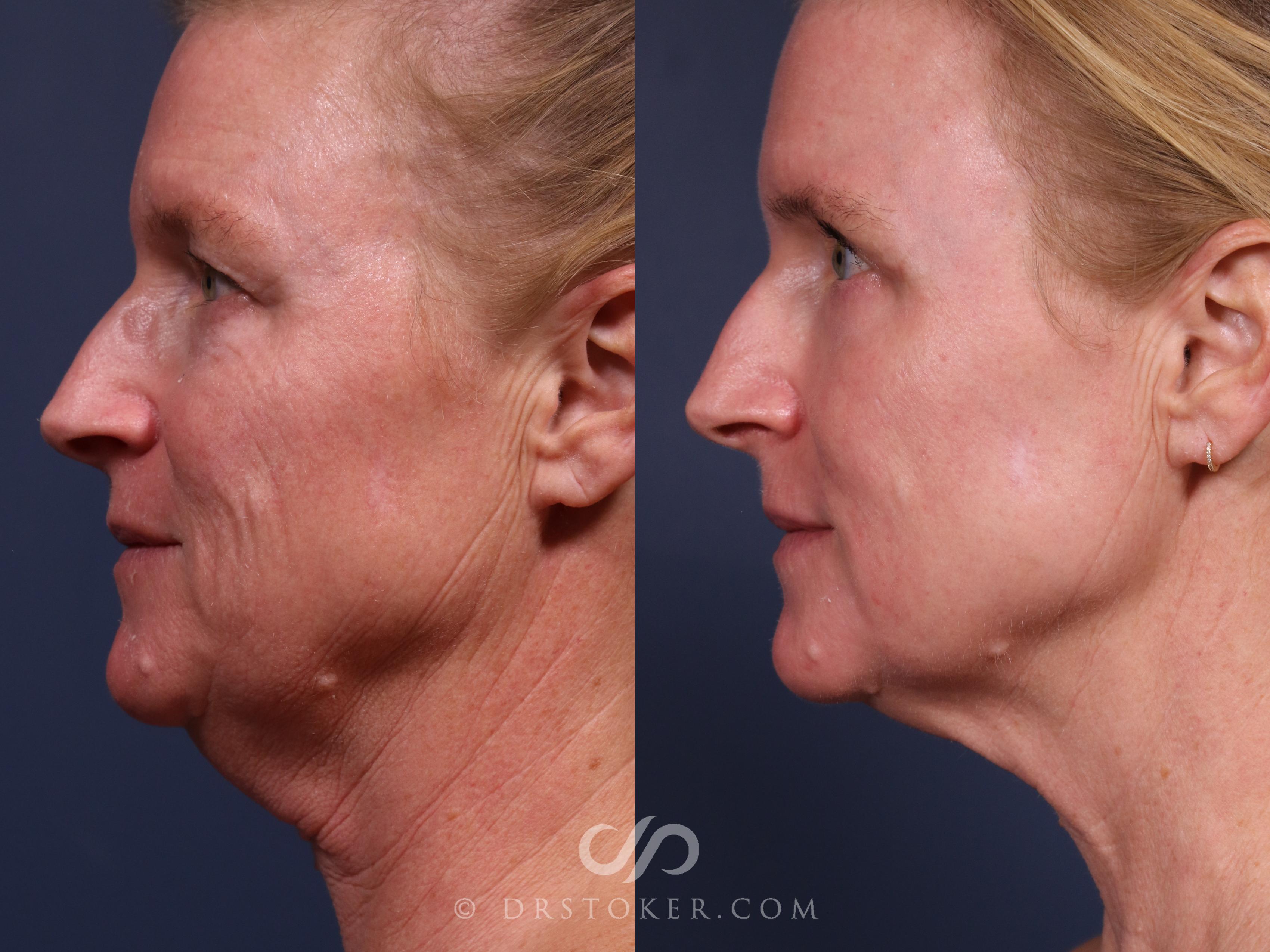 Before & After Laser Skin Resurfacing  Case 2561 Left View in Los Angeles, CA
